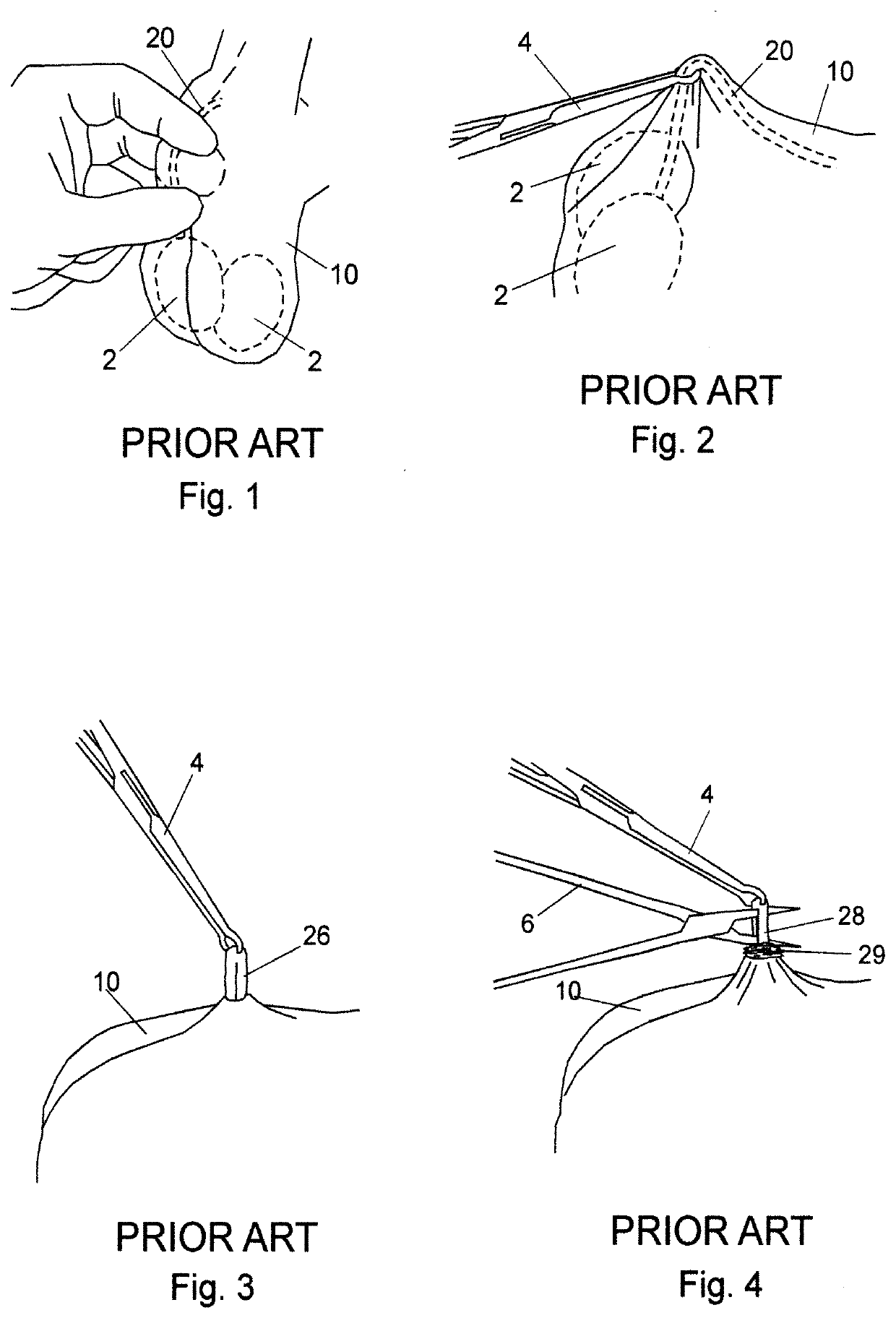 Bipolar coagulating devices and vasectomy kits associated therewith