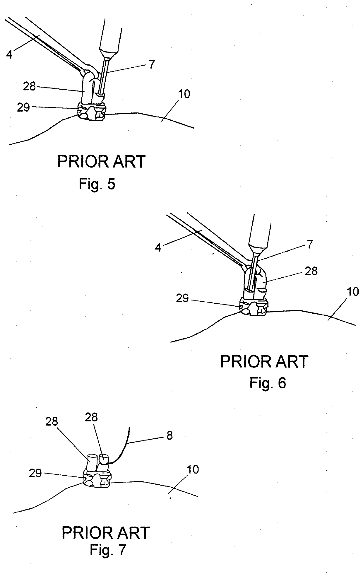 Bipolar coagulating devices and vasectomy kits associated therewith