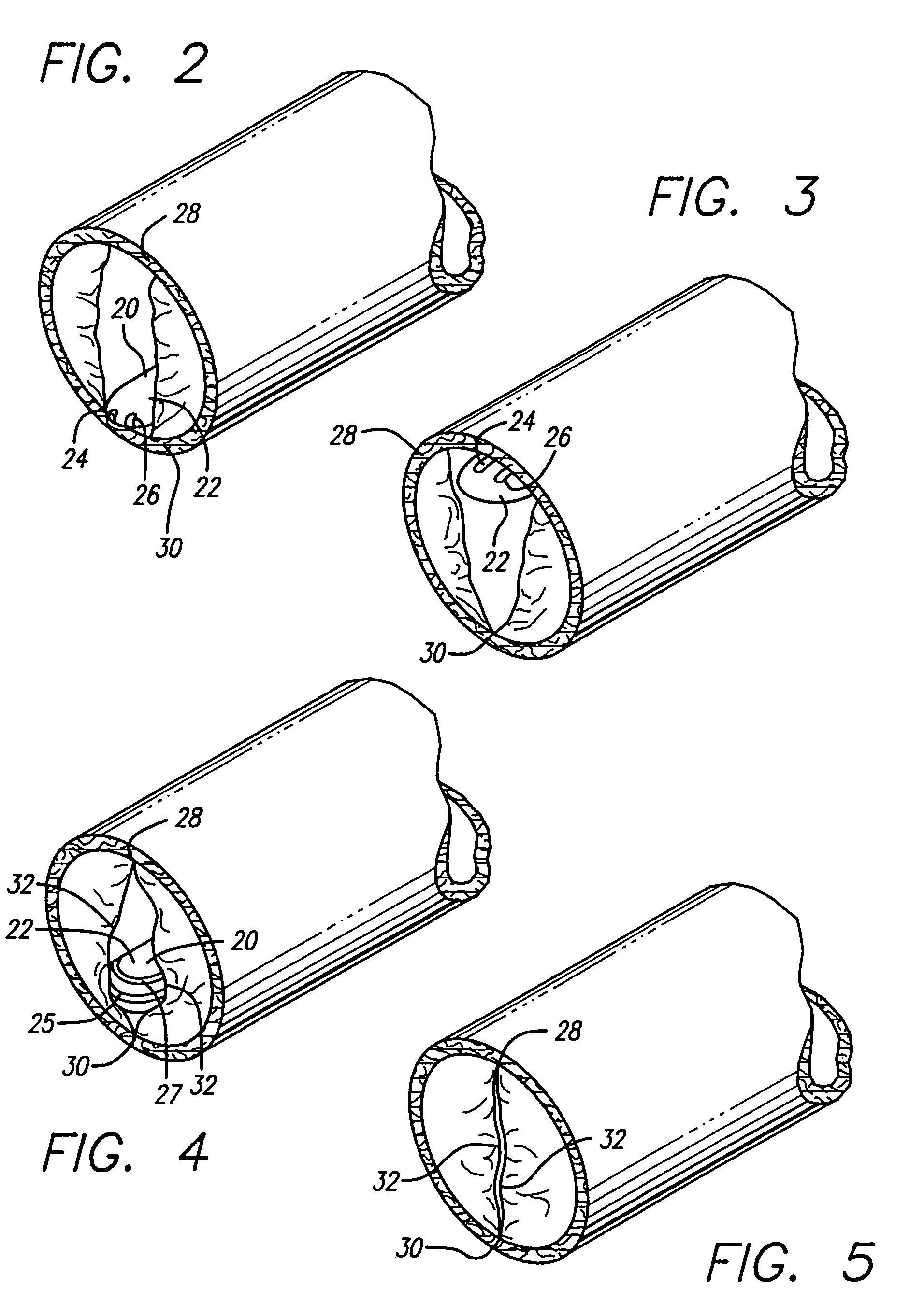 Apparatus for treating venous insufficiency using directionally applied energy