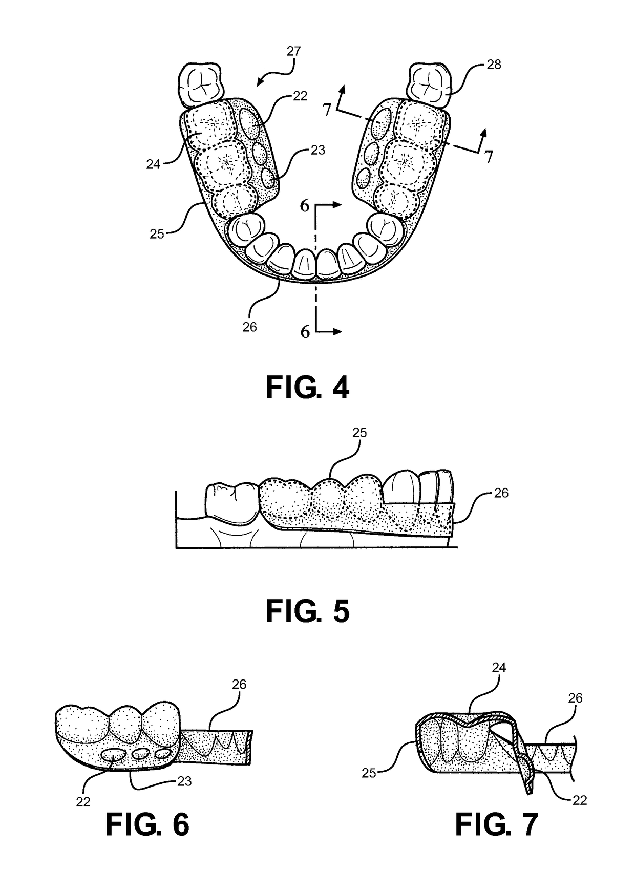 Method and oral appliance for improving air intake and reducing bruxism