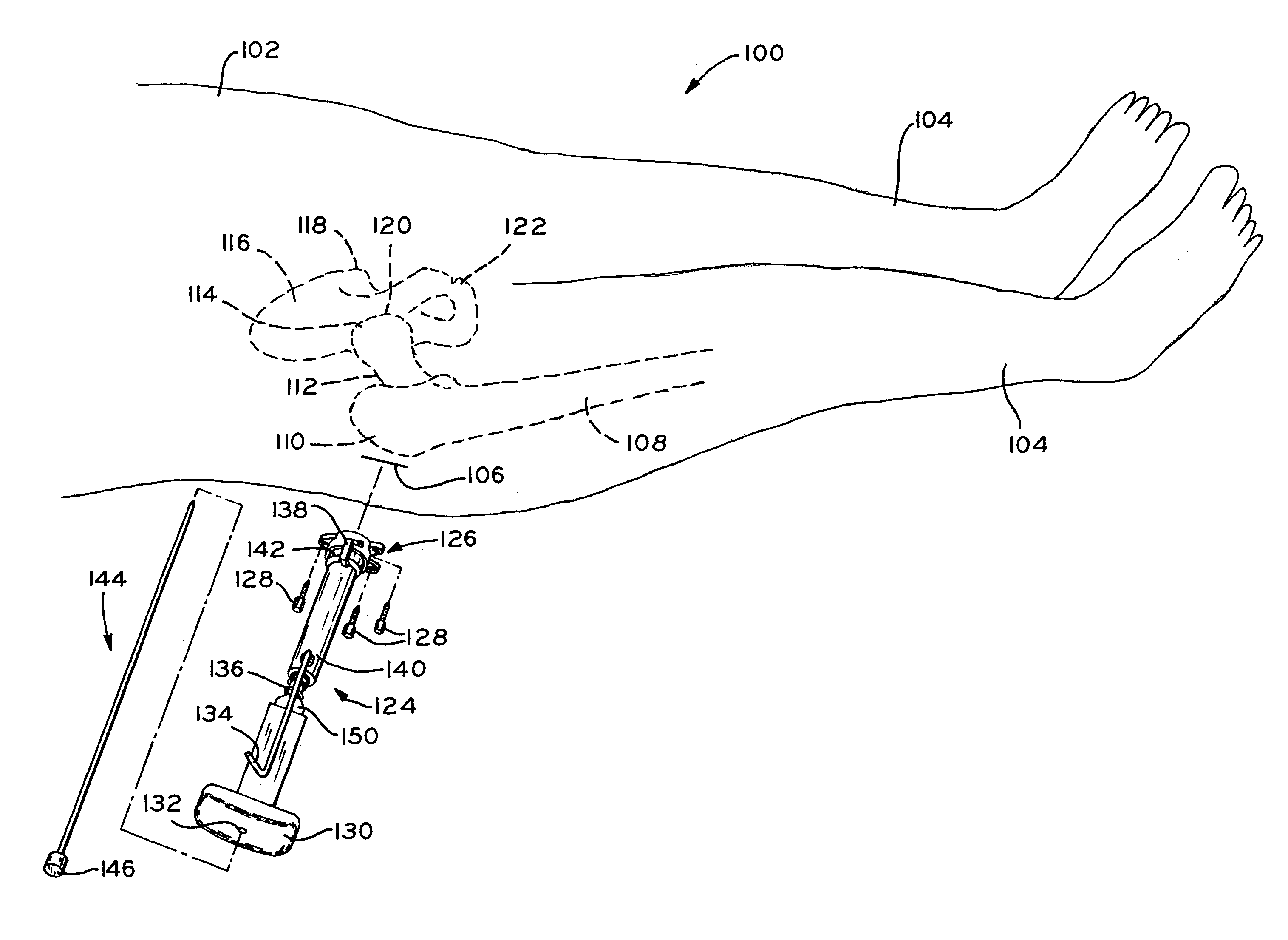 Method and apparatus for reducing femoral fractures