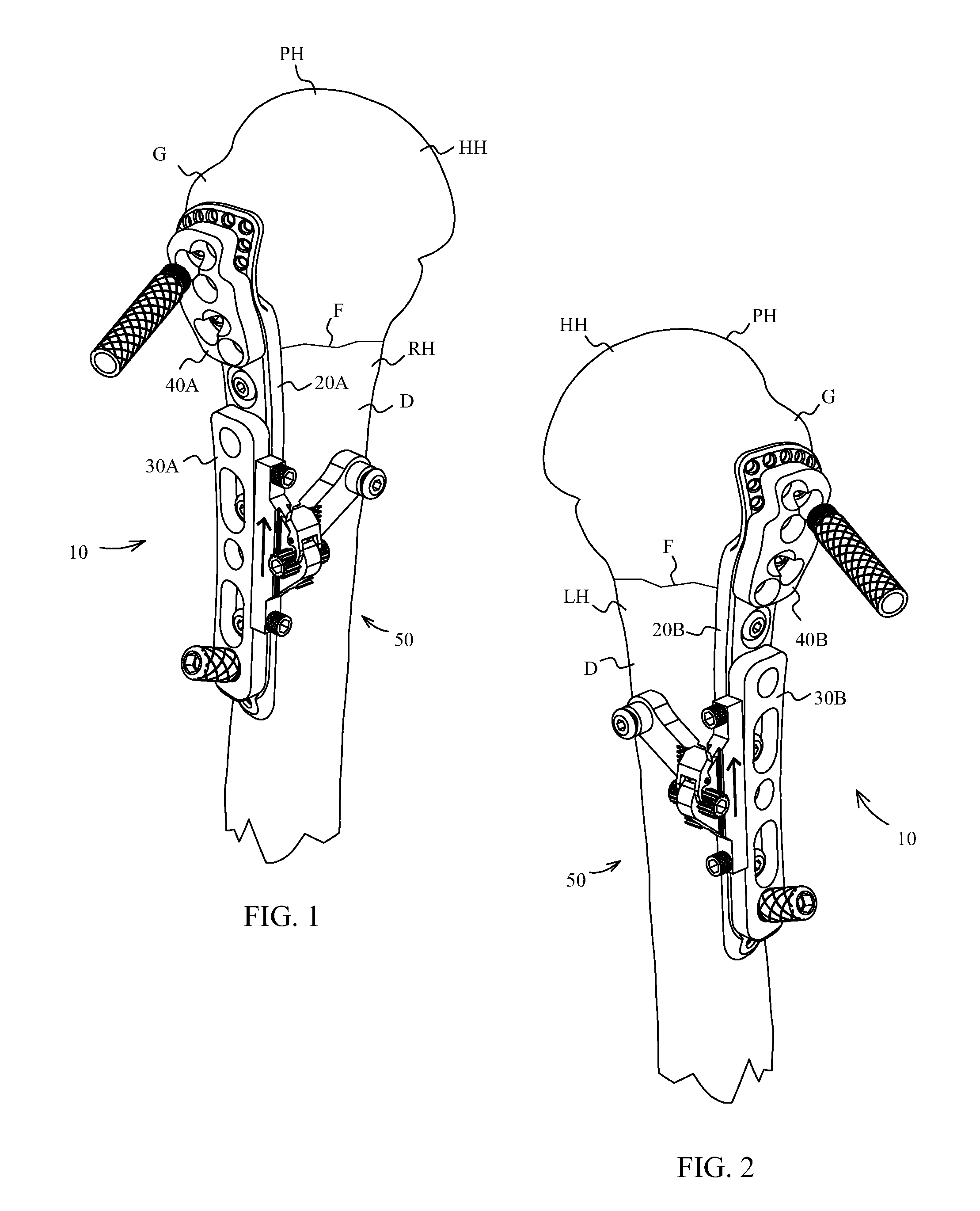 Proximal humerus fracture repair plate and system