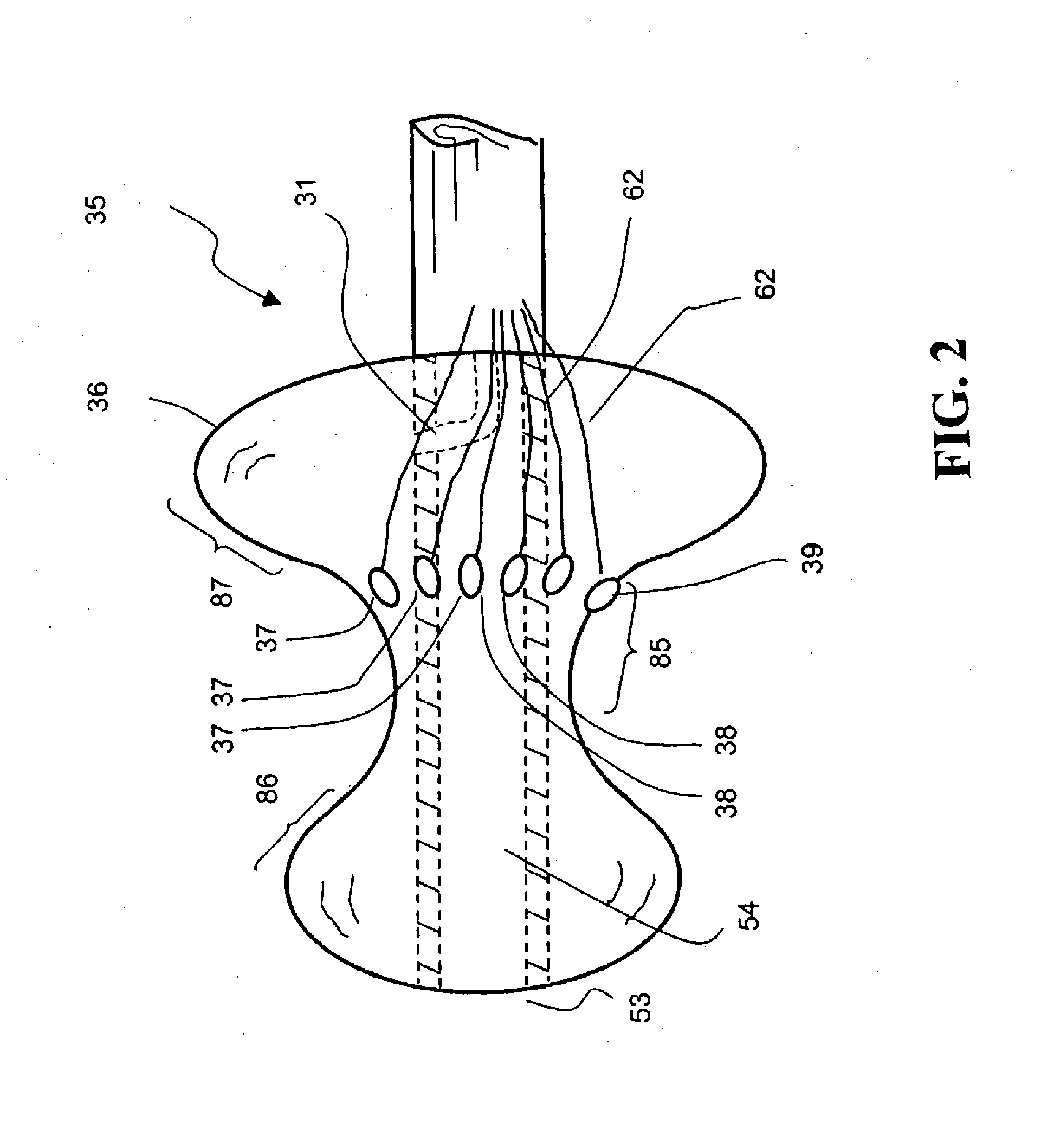 Method for treating and repairing mitral valve annulus