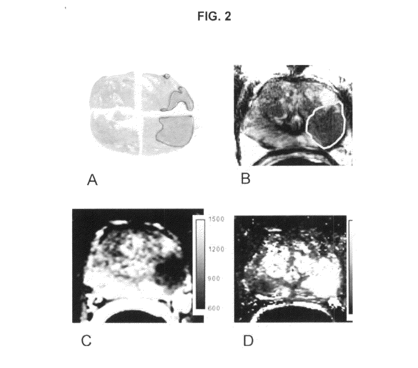 System and method of guided treatment within malignant prostate tissue