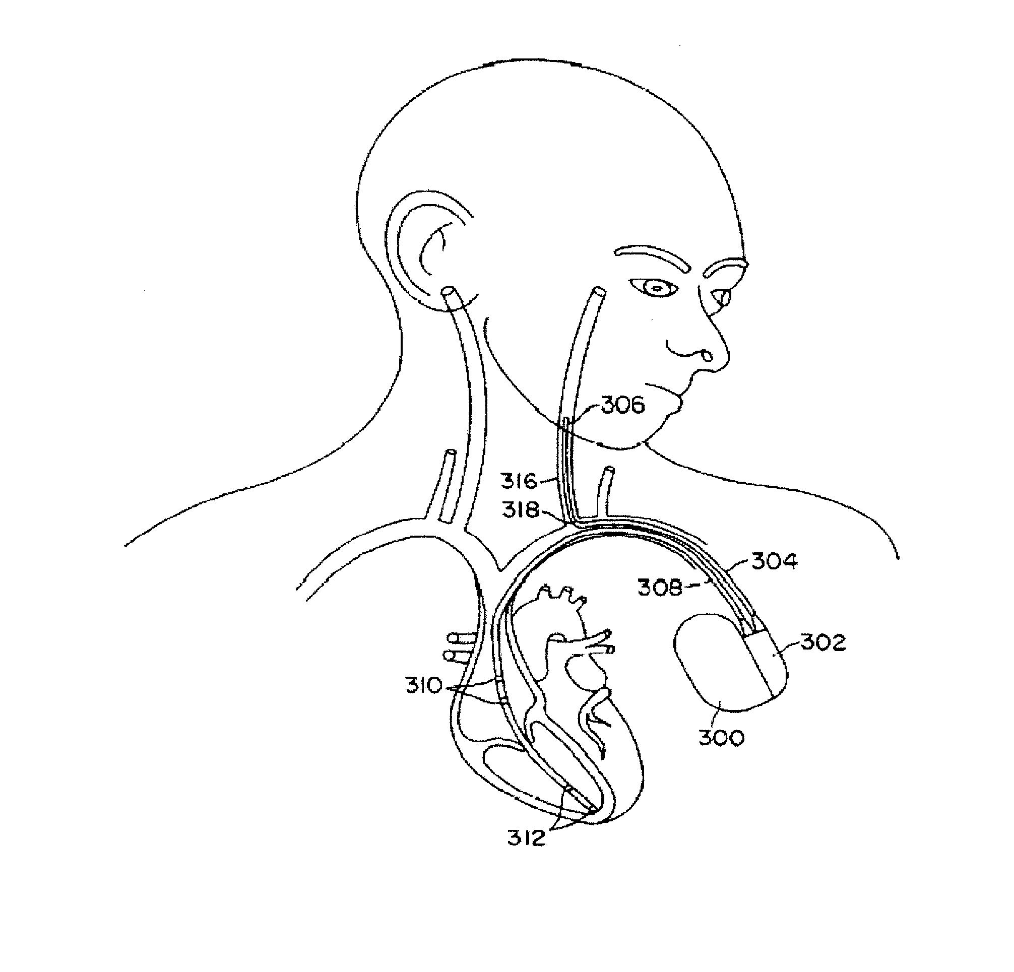 Method and system for vagal nerve stimulation with multi-site cardiac pacing