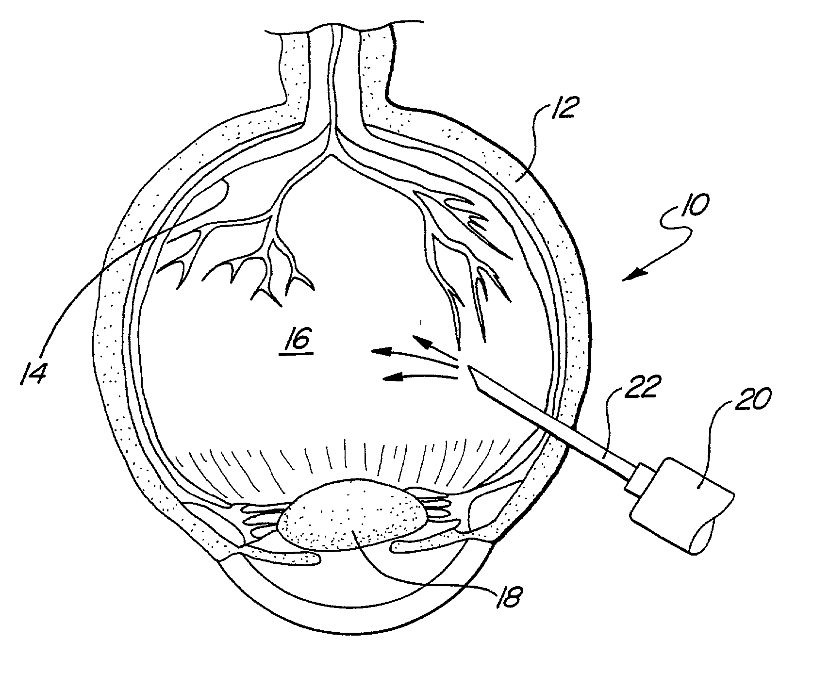 Method for creating a separation of posterior cortical vitreous from the retina of the eye