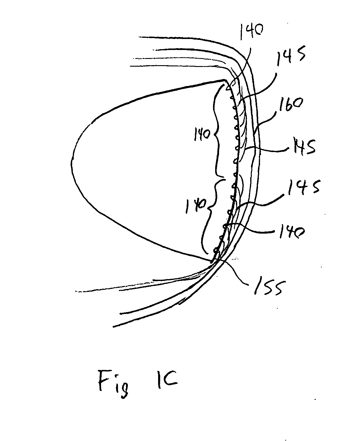 Atmospheric entry thermal protection system