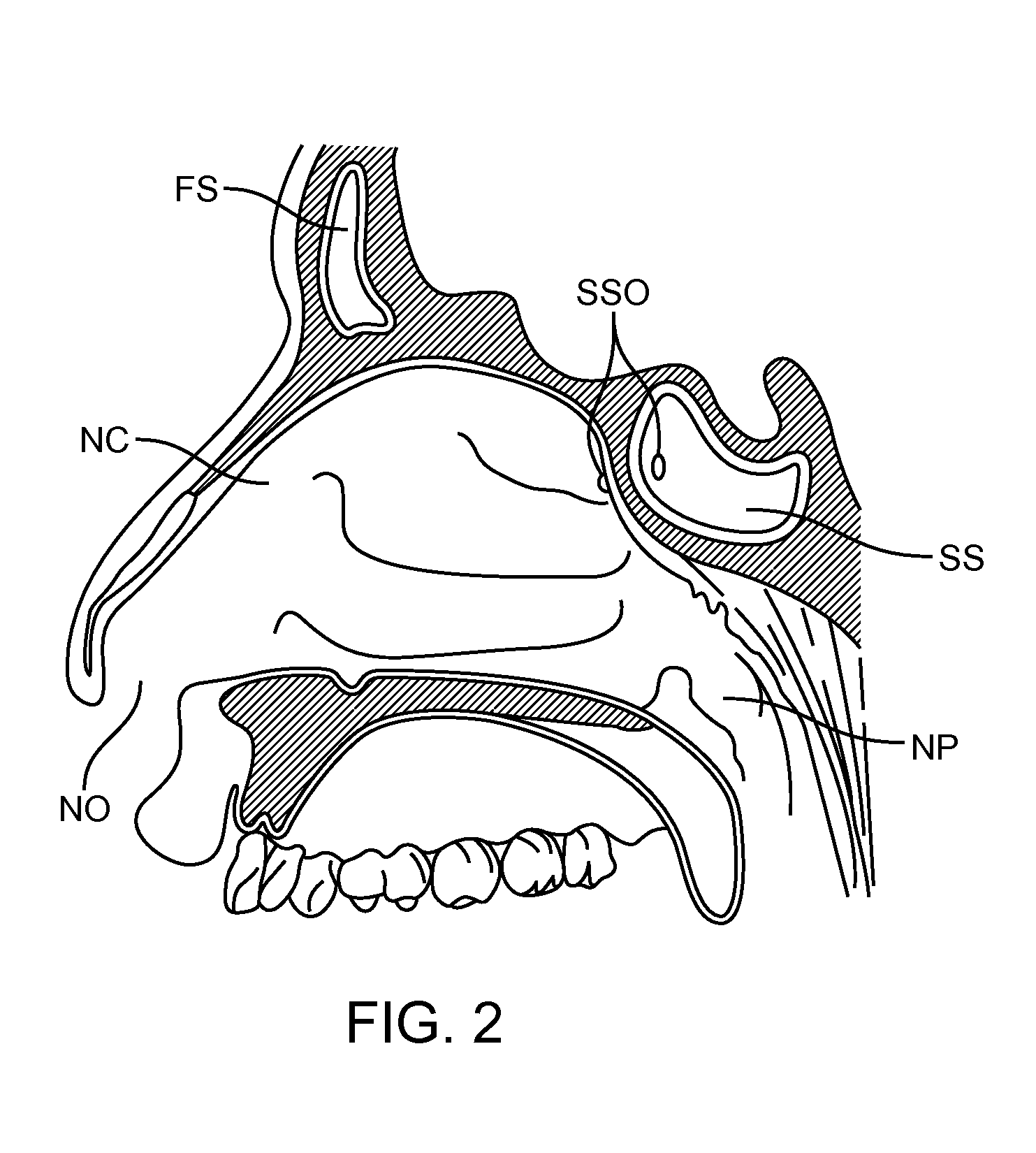 Devices and Methods for Dilating a Paranasal Sinus Opening and for Treating Sinusitis