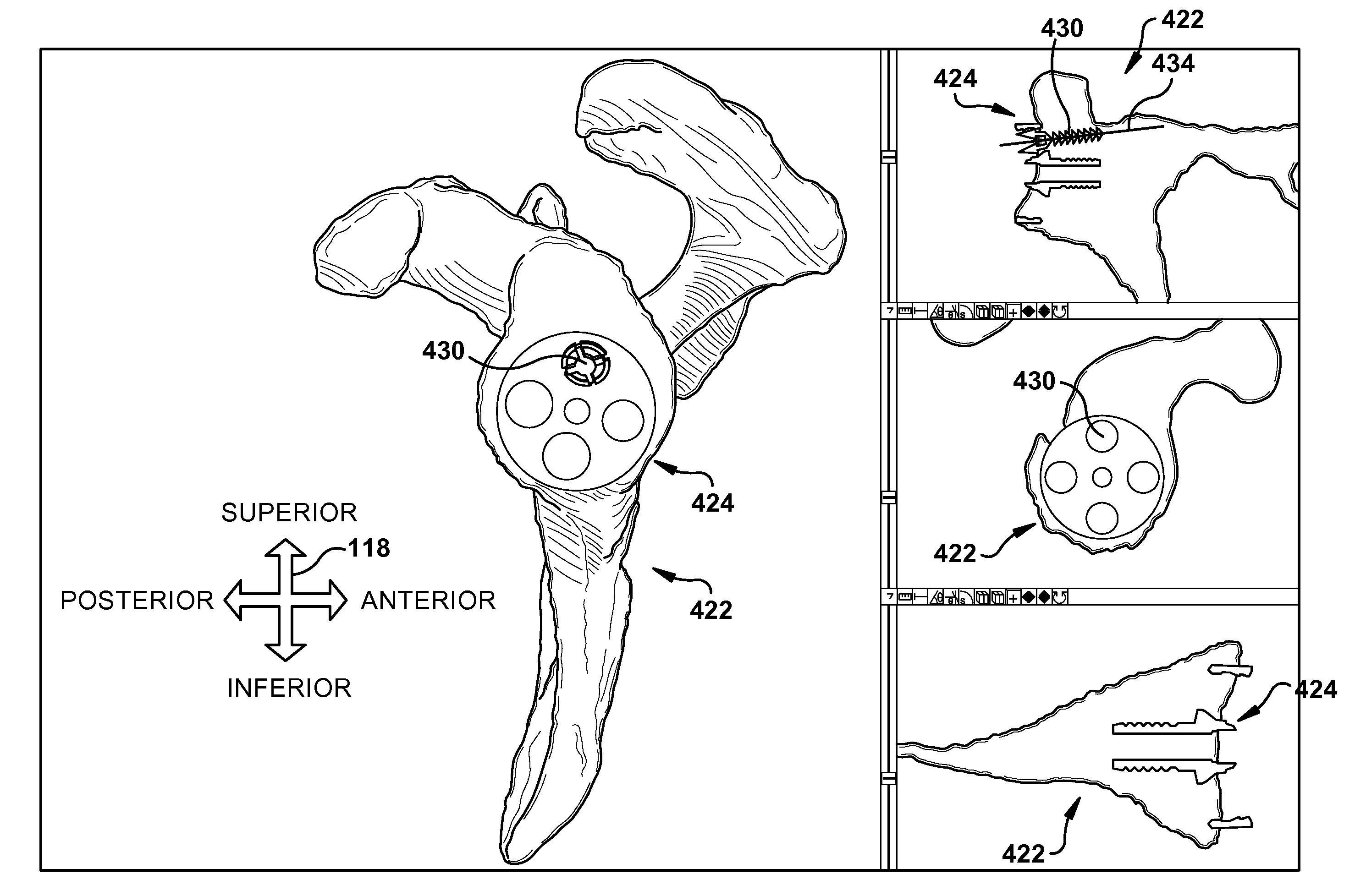 System of preoperative planning and provision of patient-specific surgical aids