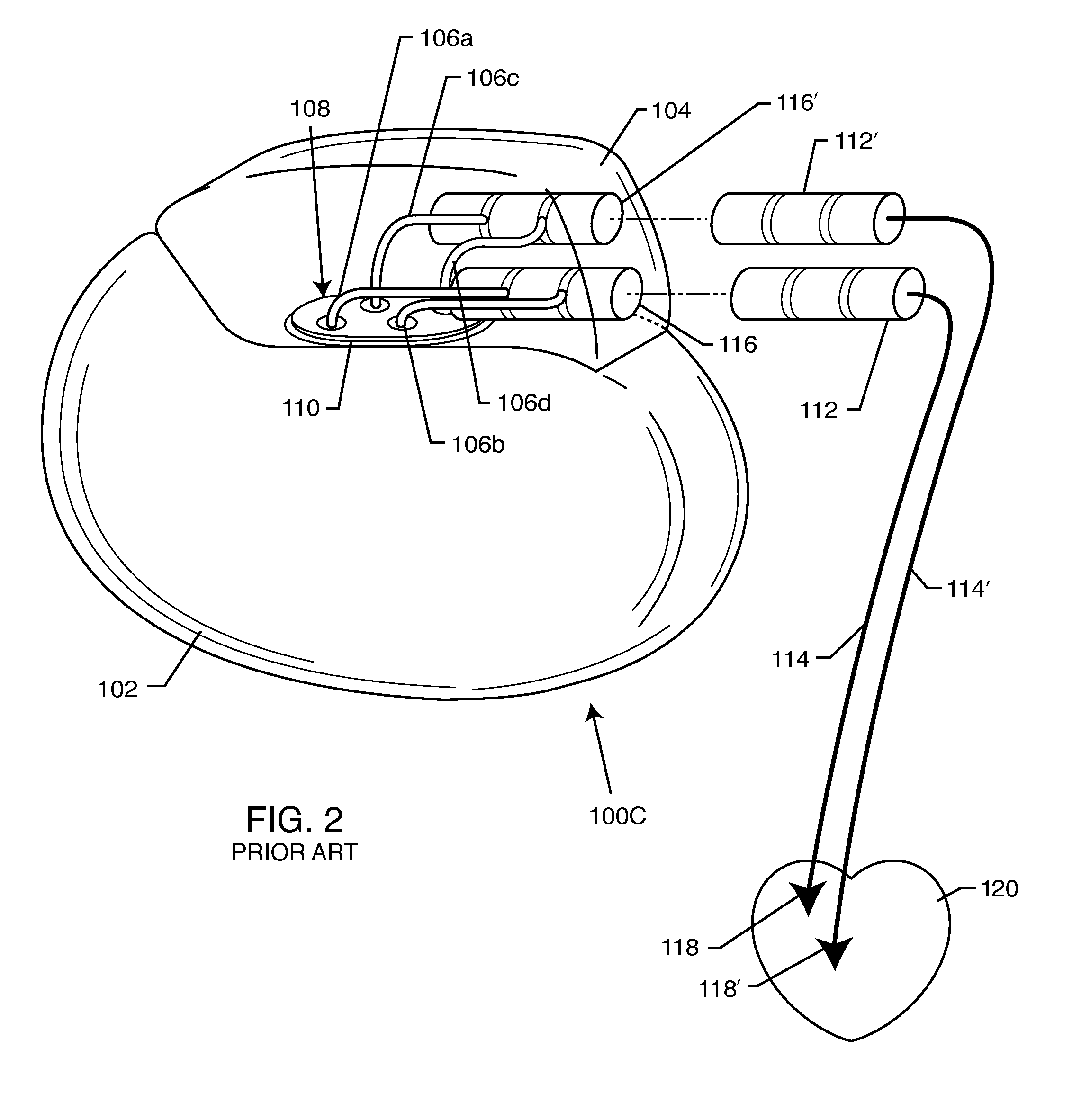 Shielded network for an active medical device implantable lead