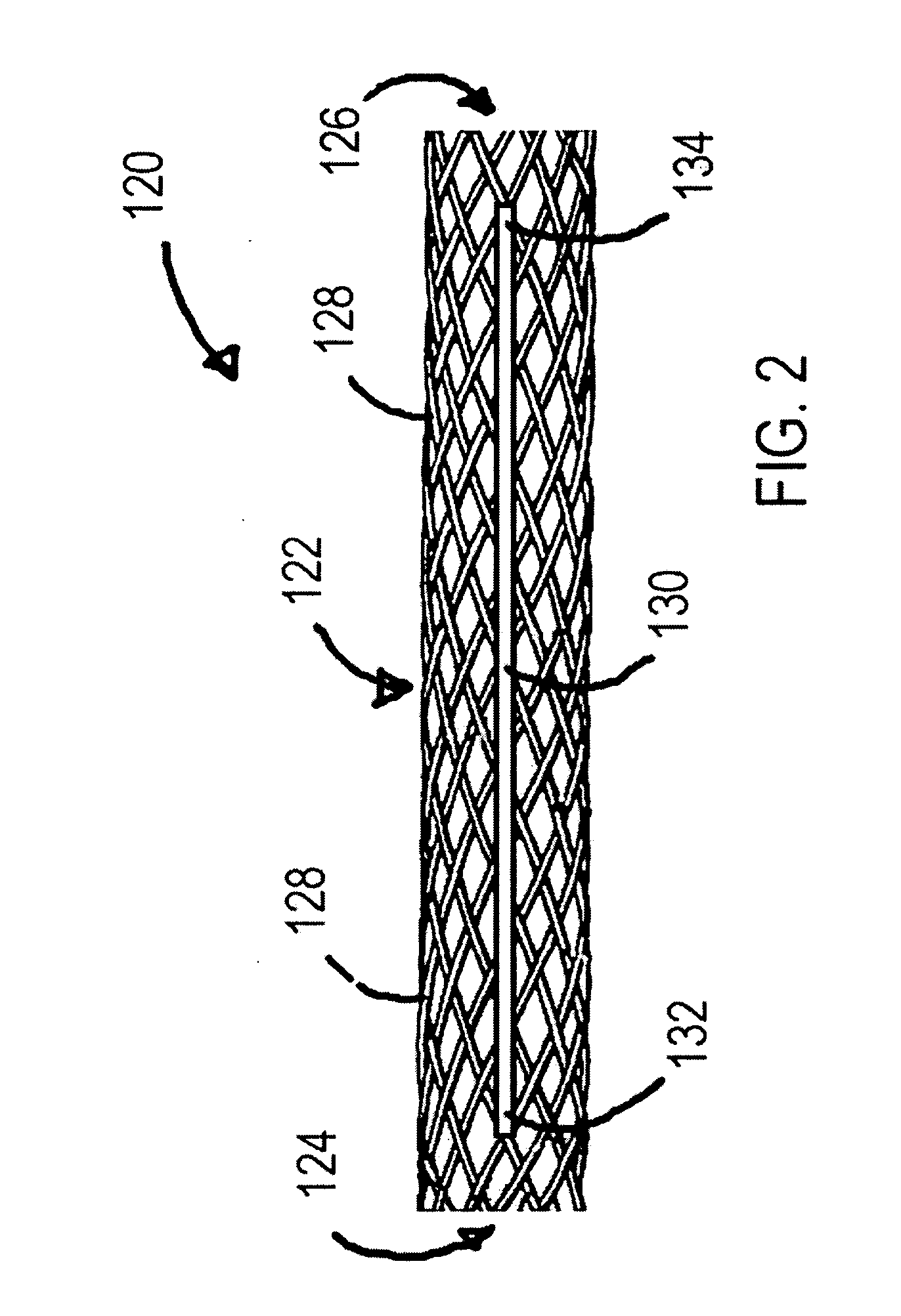 Braided Stent With a Shortenable Tether