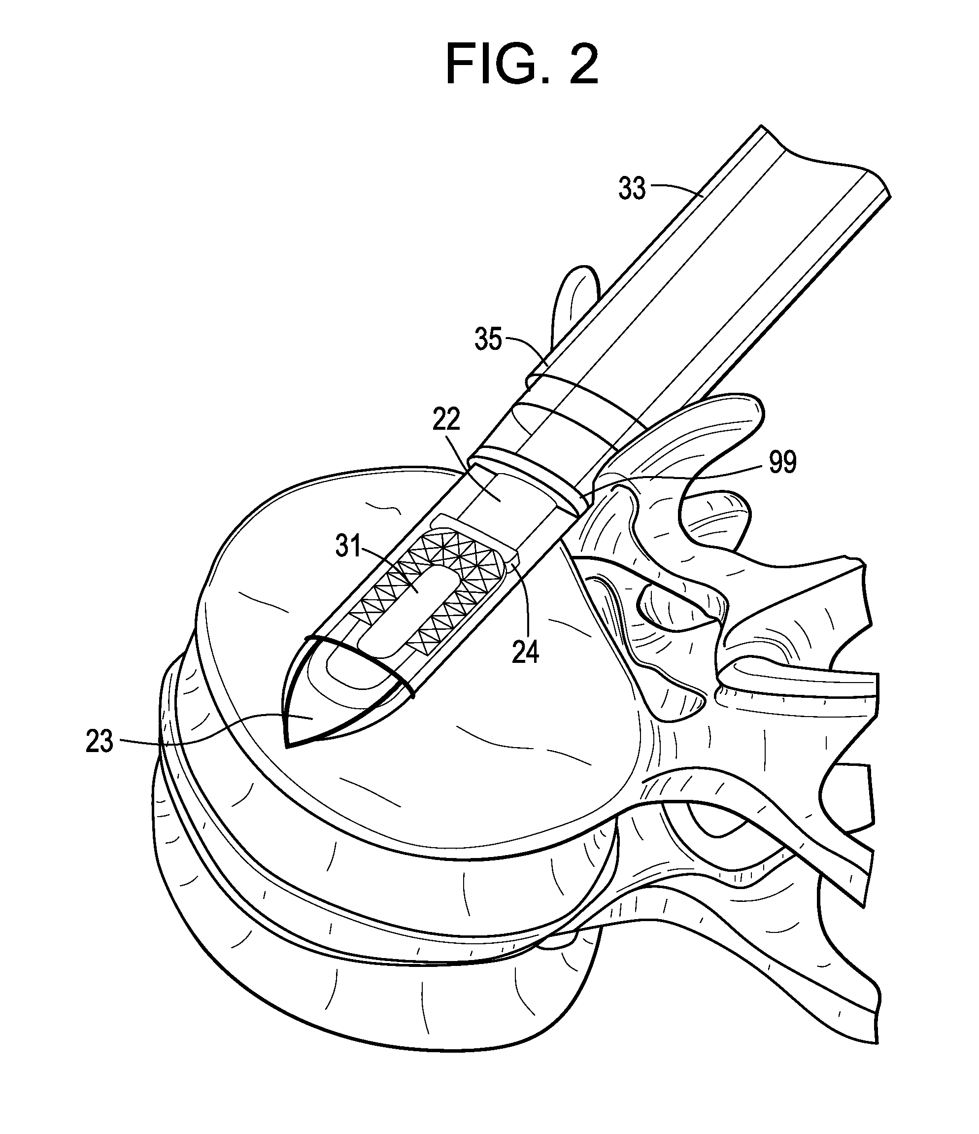 Enhanced Cage Insertion Device