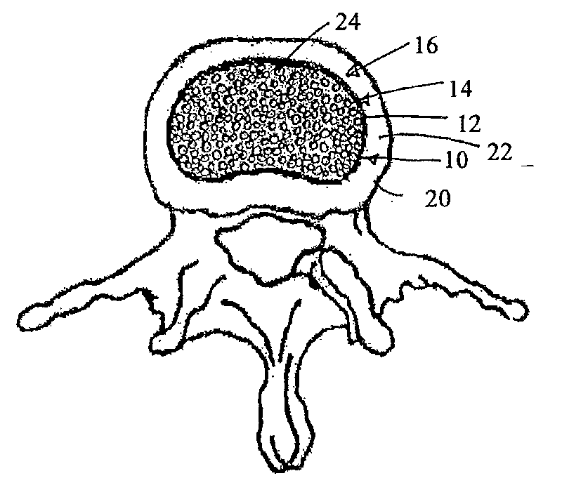 Intervertebral disc restoration