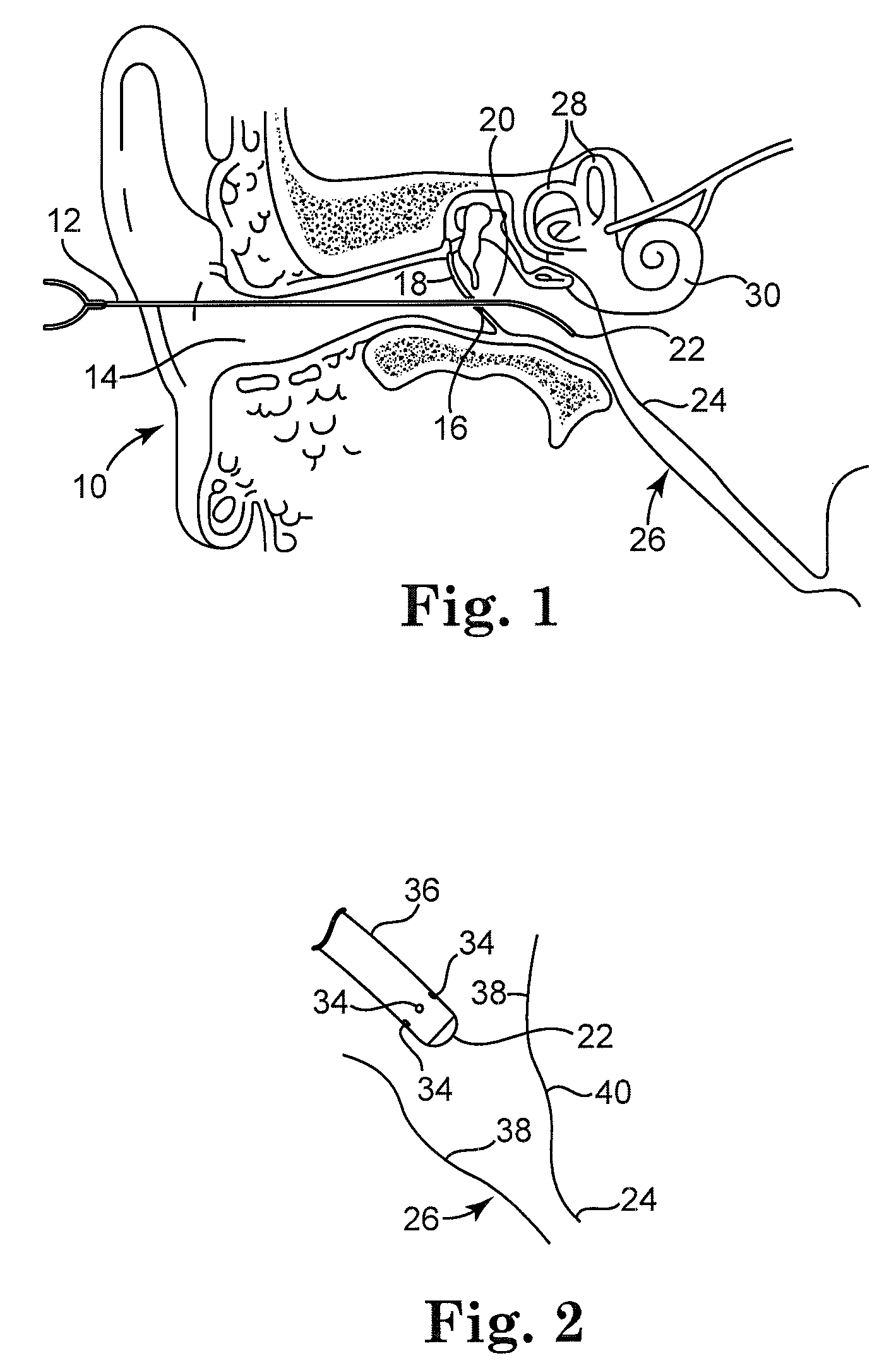 Extracellular polysaccharide solvating system for treatment of bacterial ear conditions