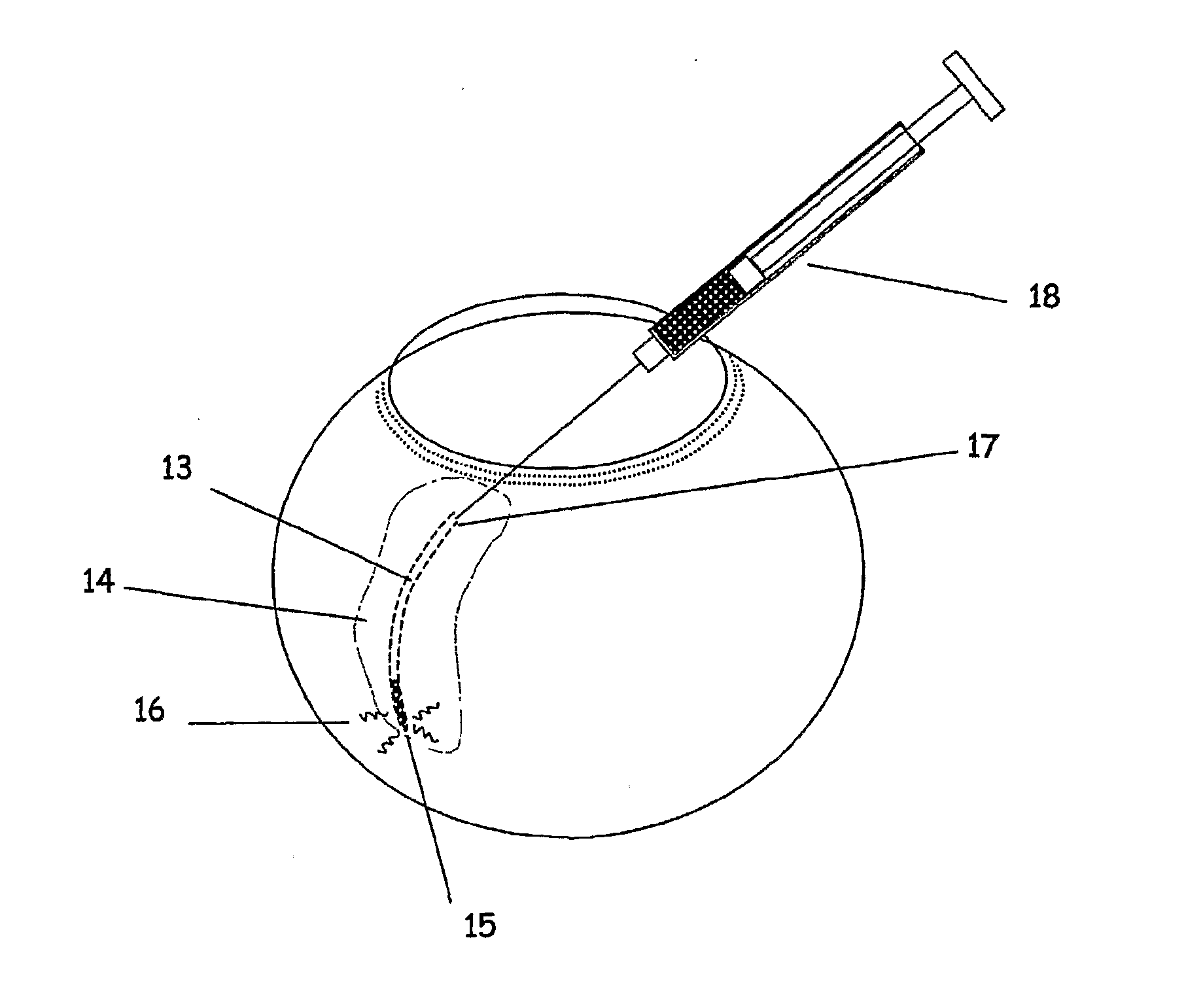 Apparatus and Method for Ocular Treatment