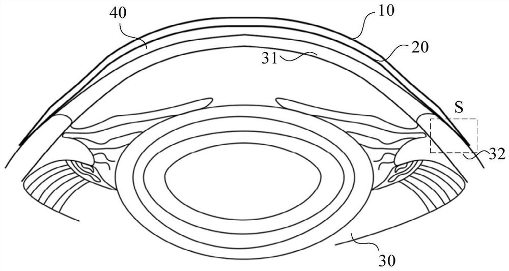 Sclera contact lens matching method