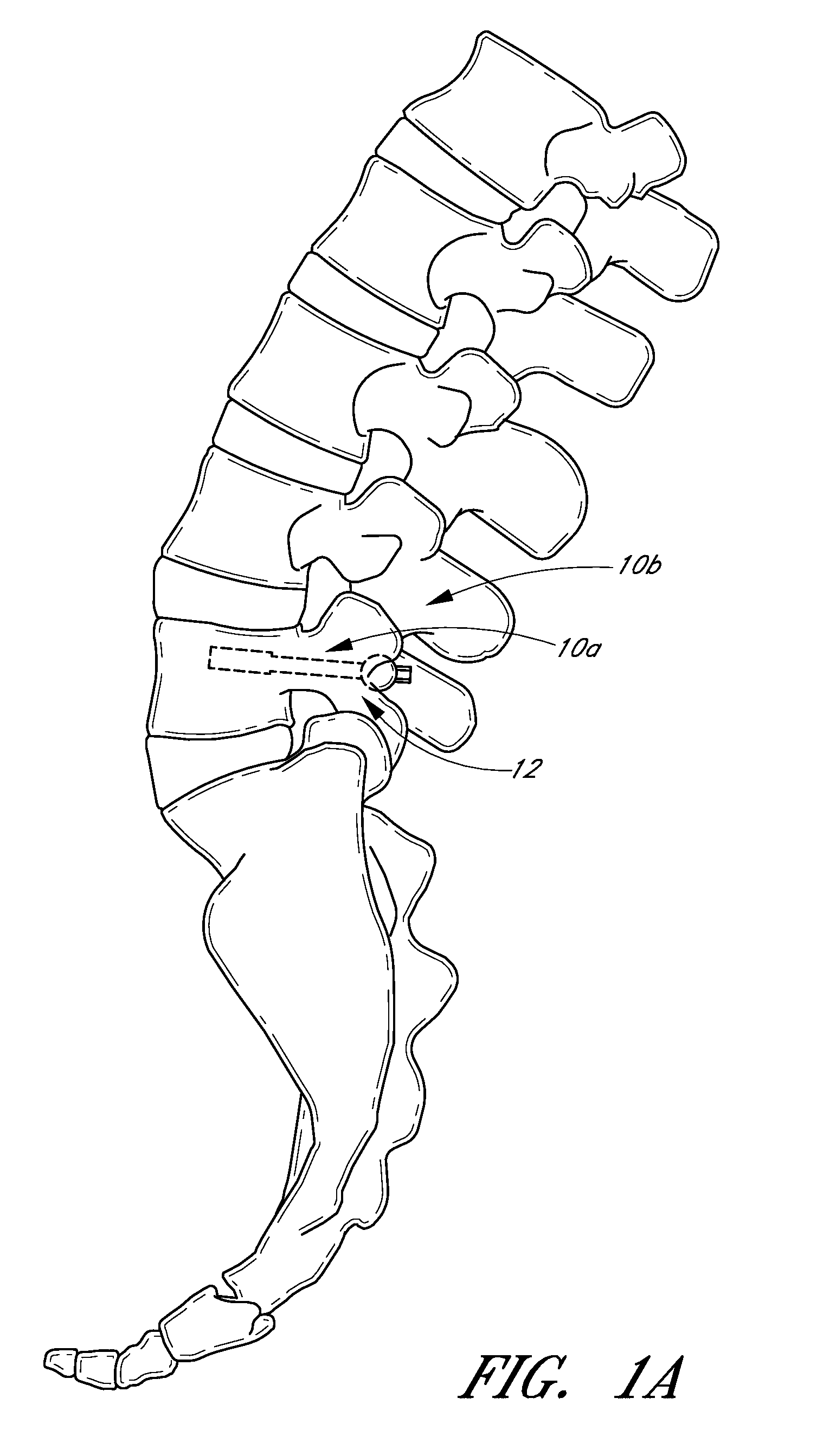 Method and apparatus for spinal stabilization