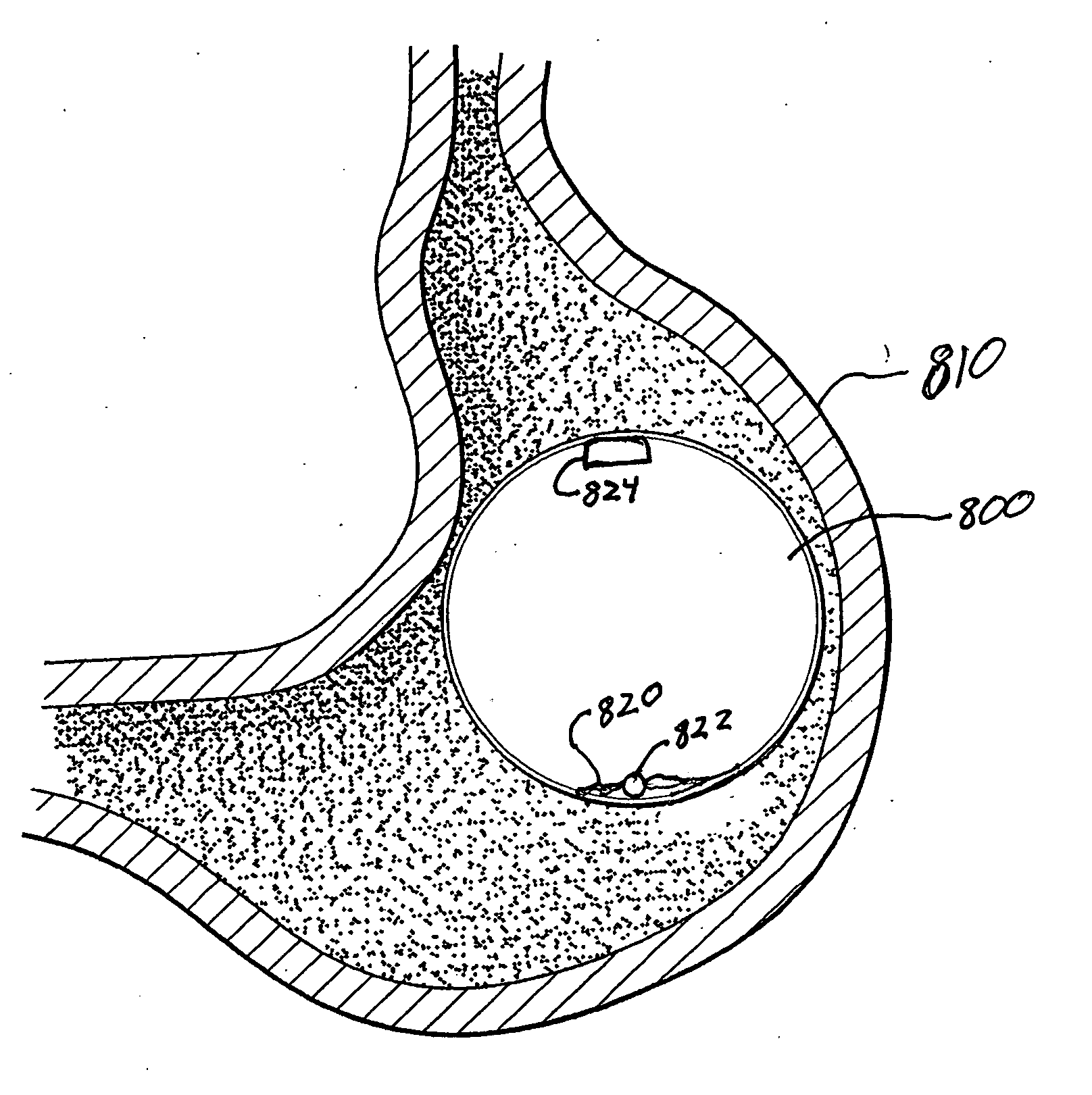 Intragastric volume-occupying device