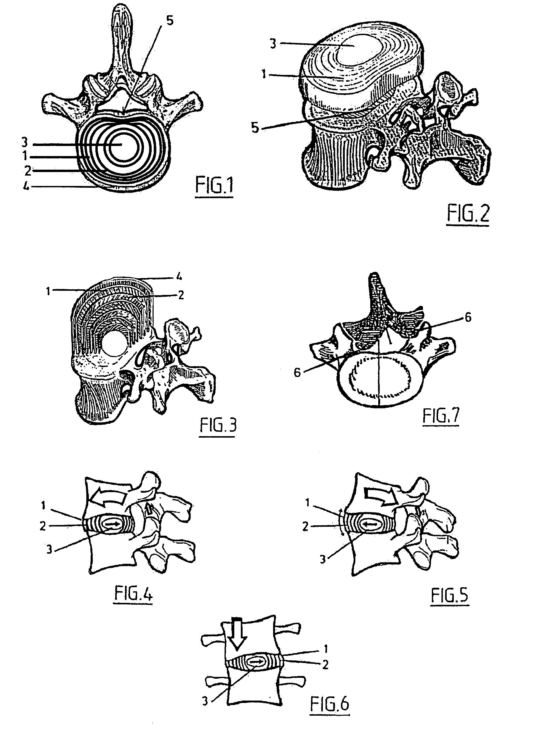 Intervertebral nucleus prosthesis and surgical procedure for implanting the same