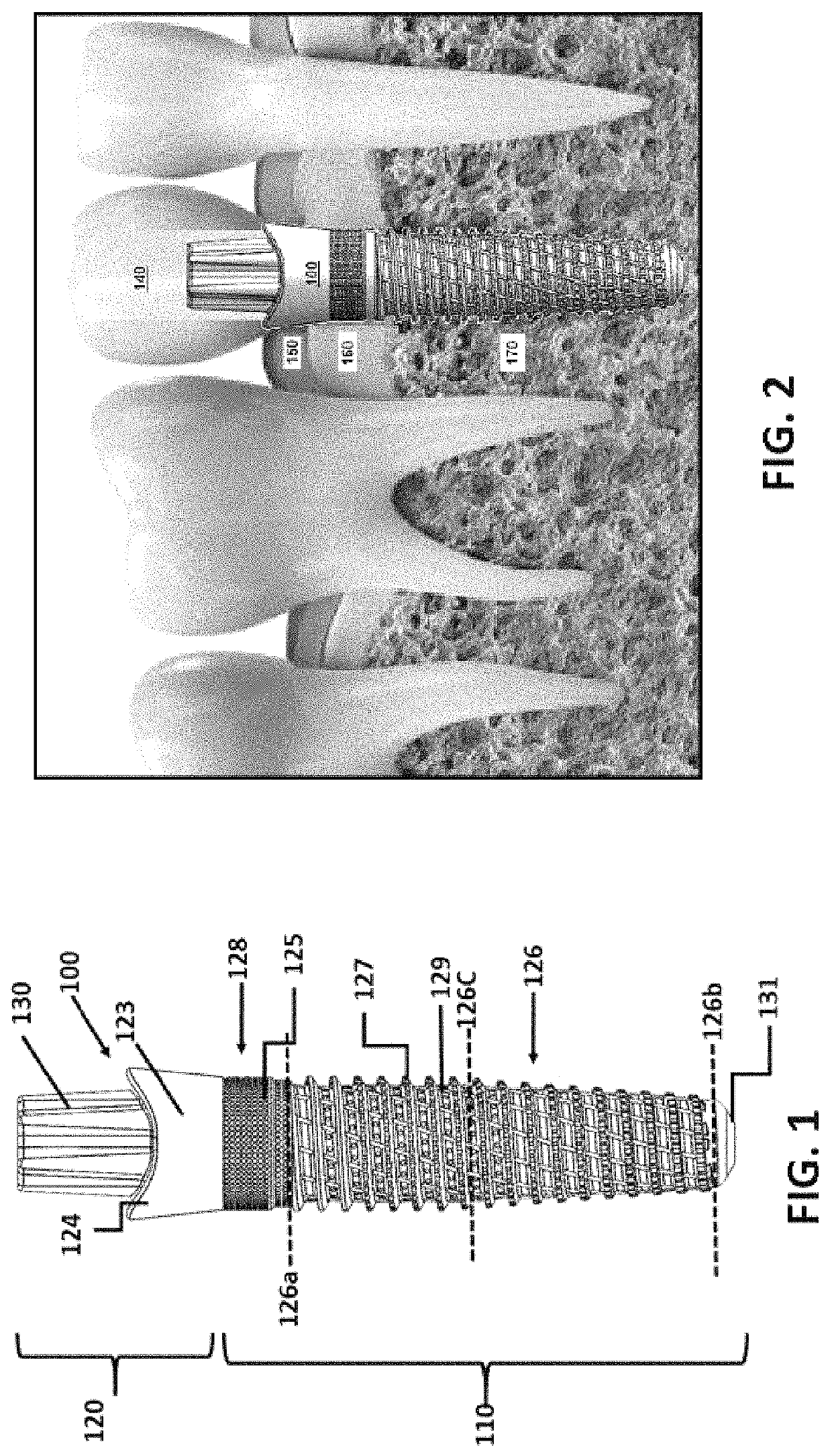 Osseointegrative surgical implant