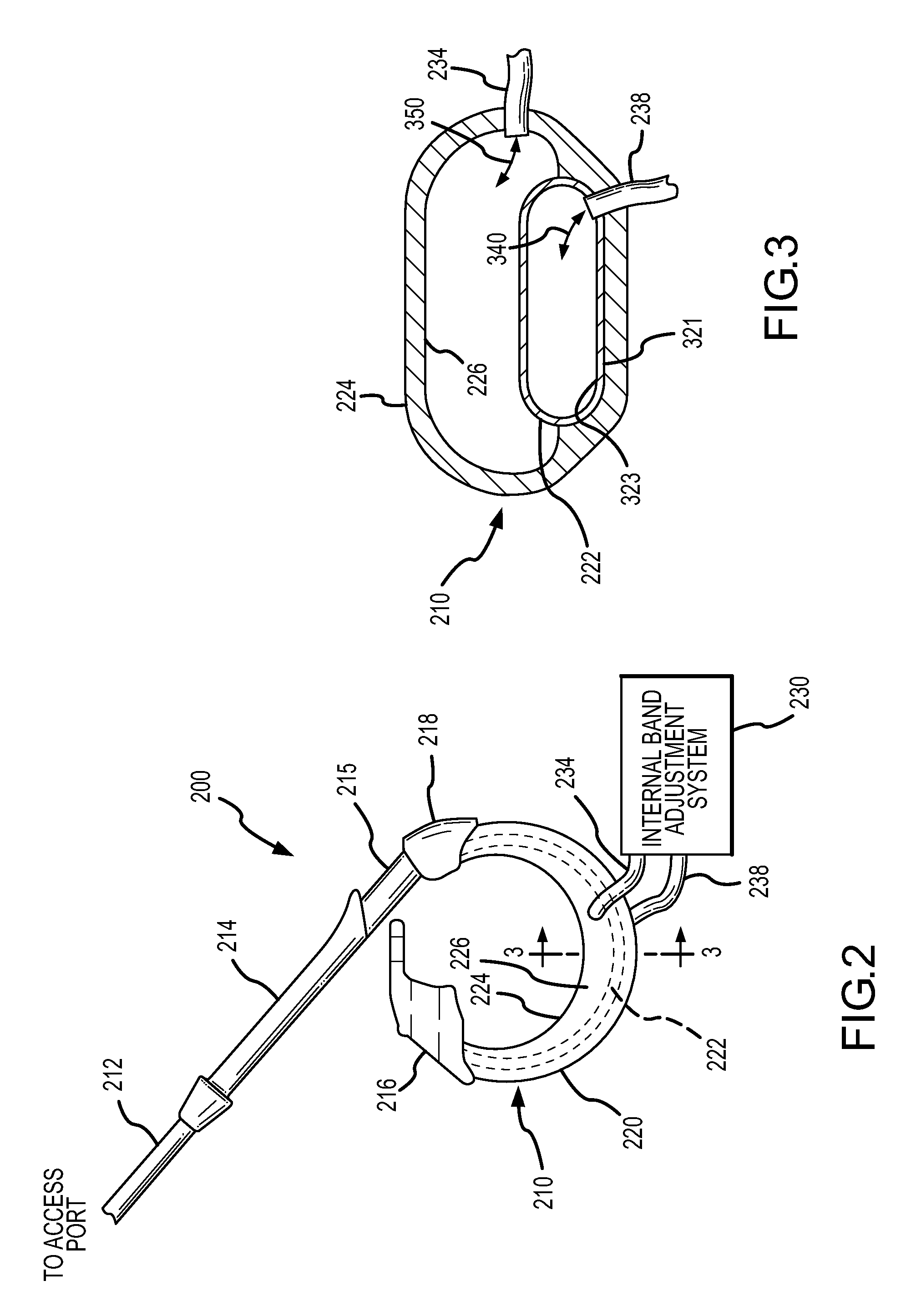Hydraulic gastric band with collapsible reservoir