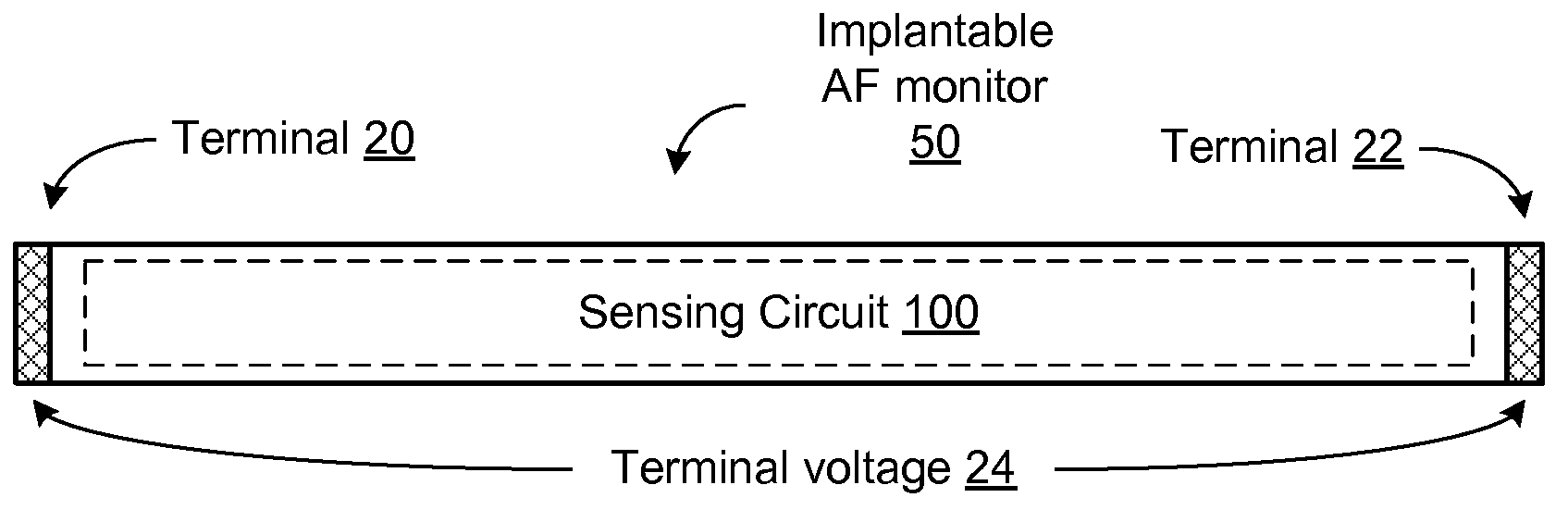 Needle implantable atrial fibrillation monitor and methods for use therewith