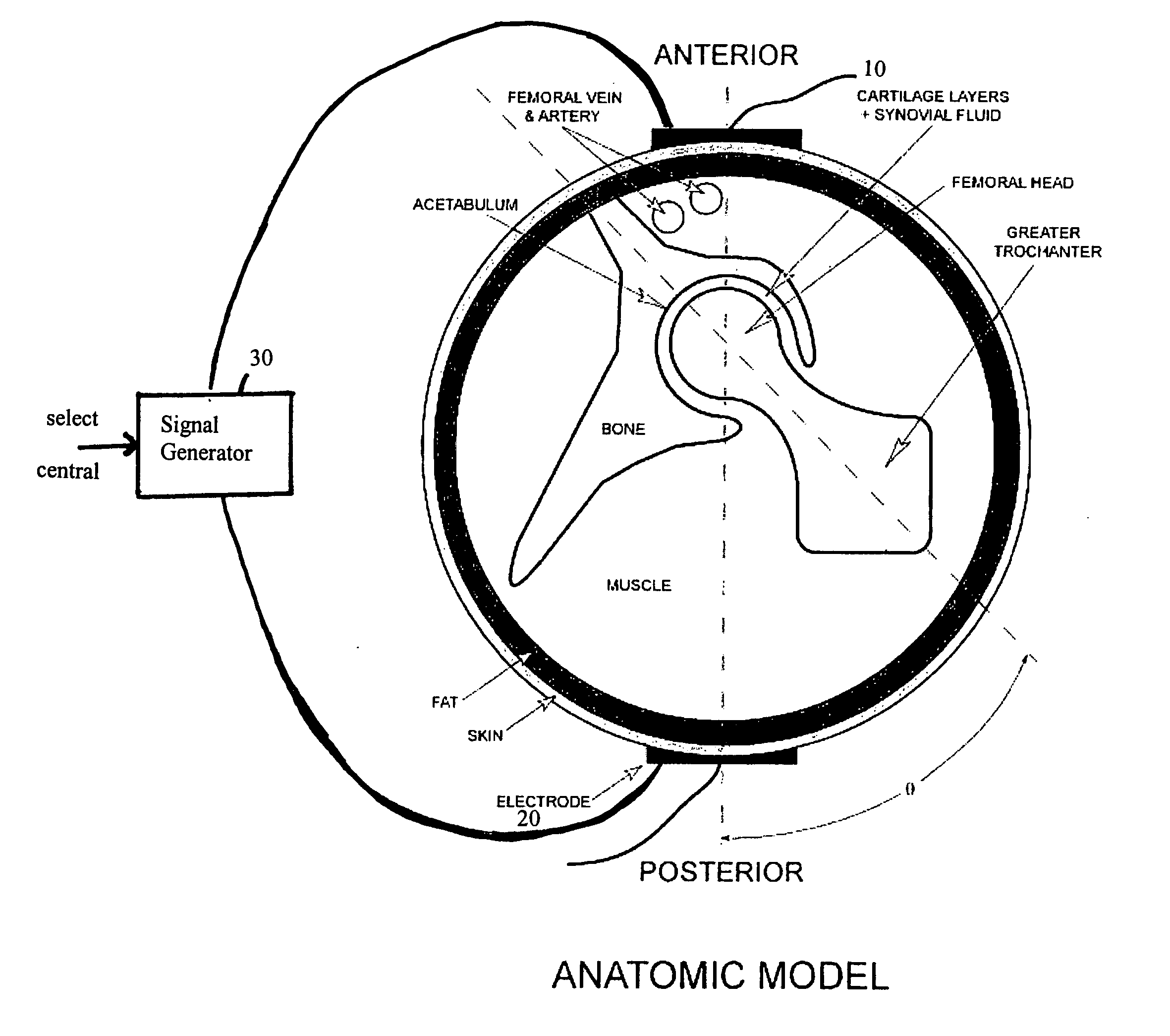 Method and device for treating osteoarthritis and cartilage disease, defects, and injuries in the human hip