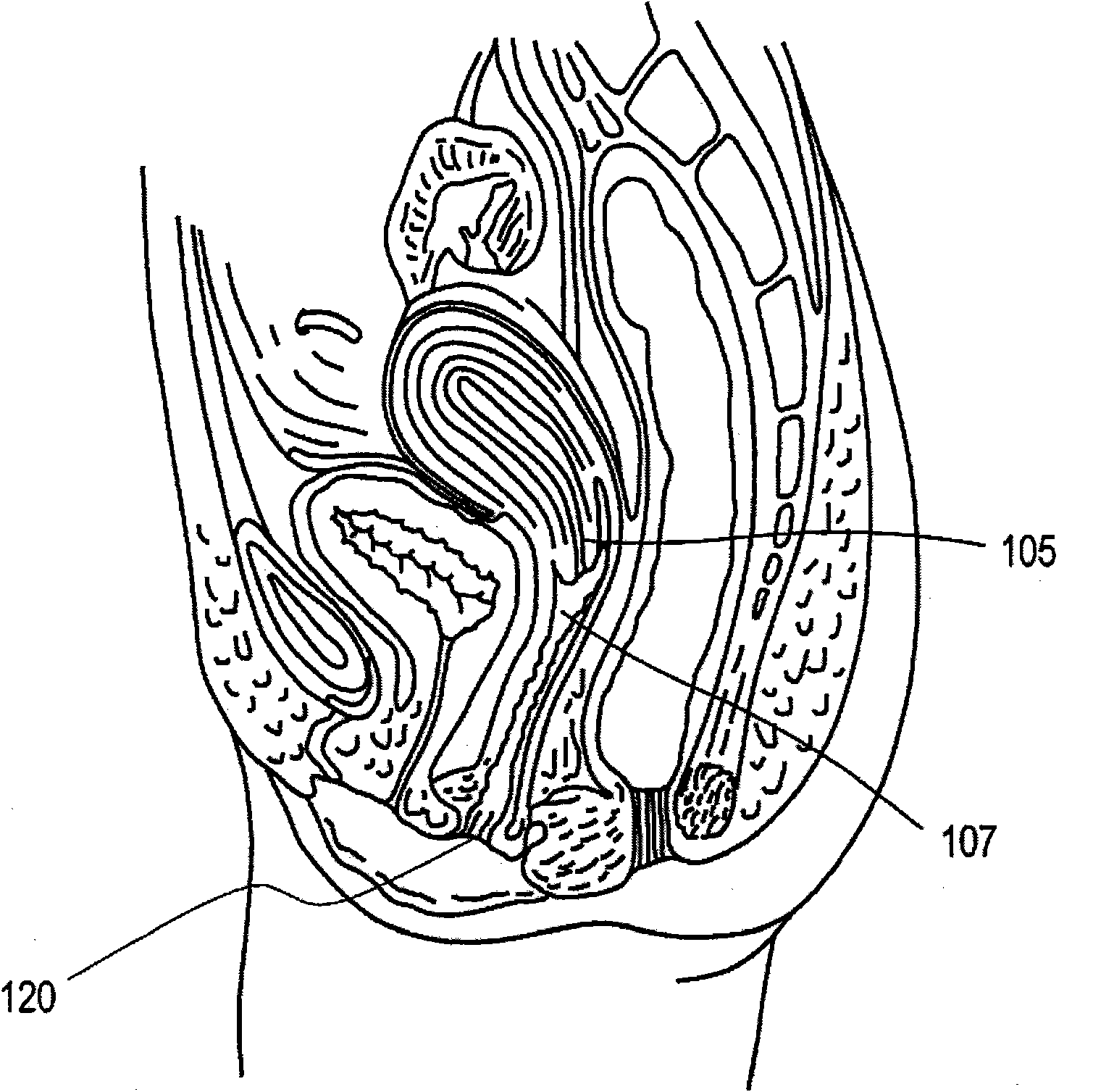 Intra-vaginal devices, device equipment and equipment for providing therapeutic heat to cervical area