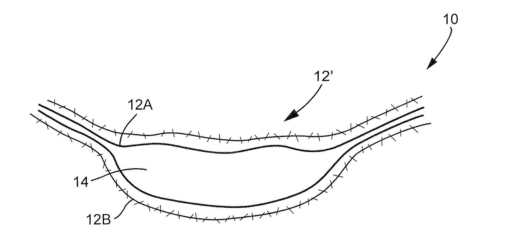 Transpedicular, Extrapedicular and Transcorporeal Approaches to the Intervertebral Discs