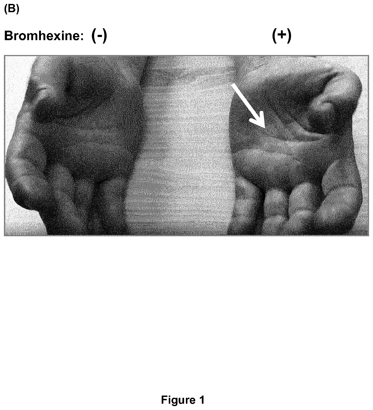 Bromhexine for the treatment of pain