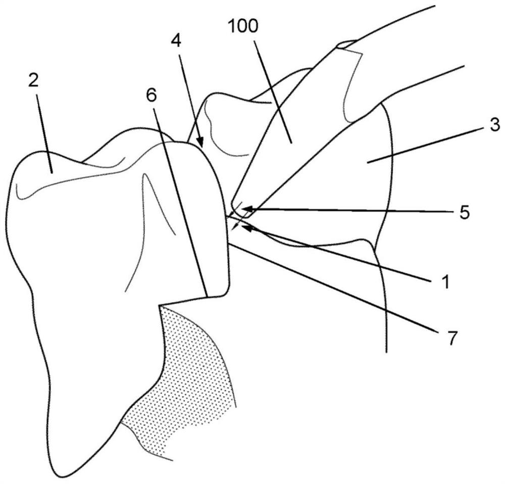 Periodontal pocket for directing flow of irrigation fluid in mouth of subject