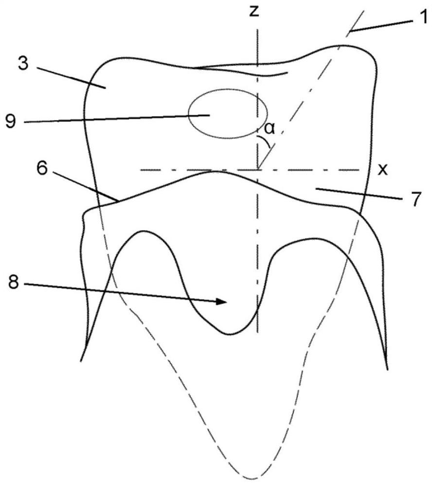 Periodontal pocket for directing flow of irrigation fluid in mouth of subject