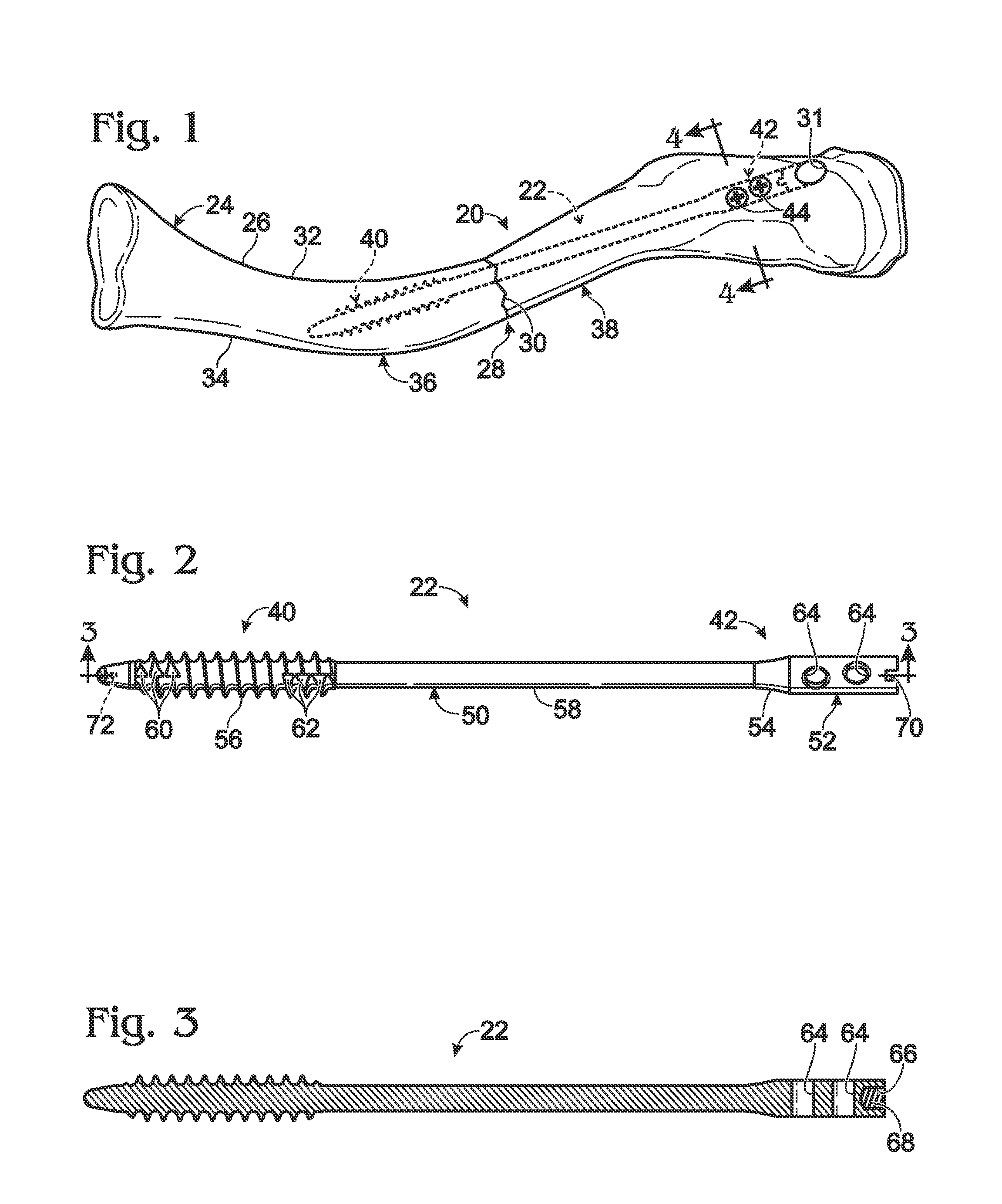 Bone fixation using an intramedullary pin