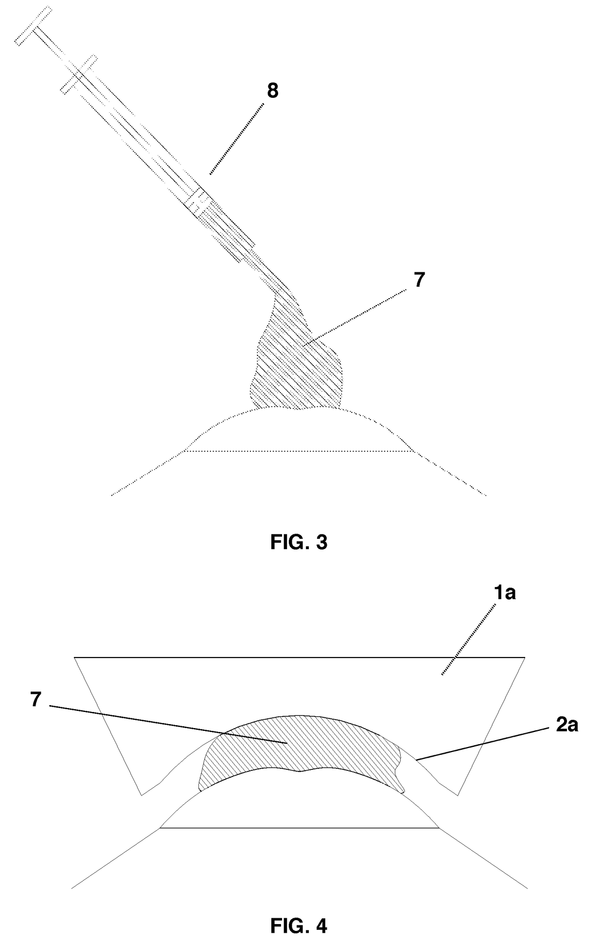System for Correcting an Irregular Surface of a Cornea and Uses Thereof