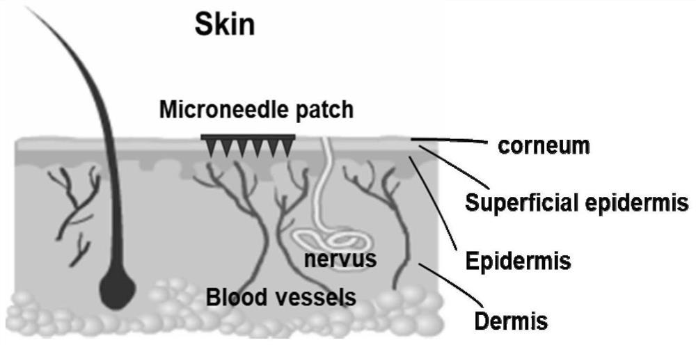 Recombinant hirudin microneedle drug delivery system and preparation method thereof