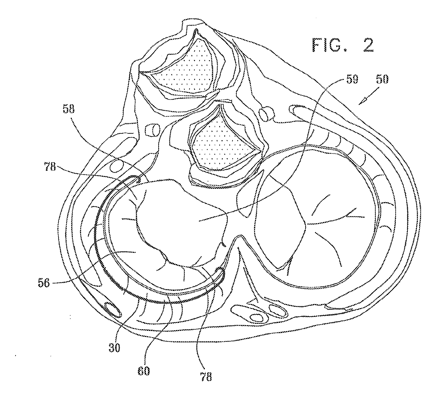 Mitral valve treatment techniques