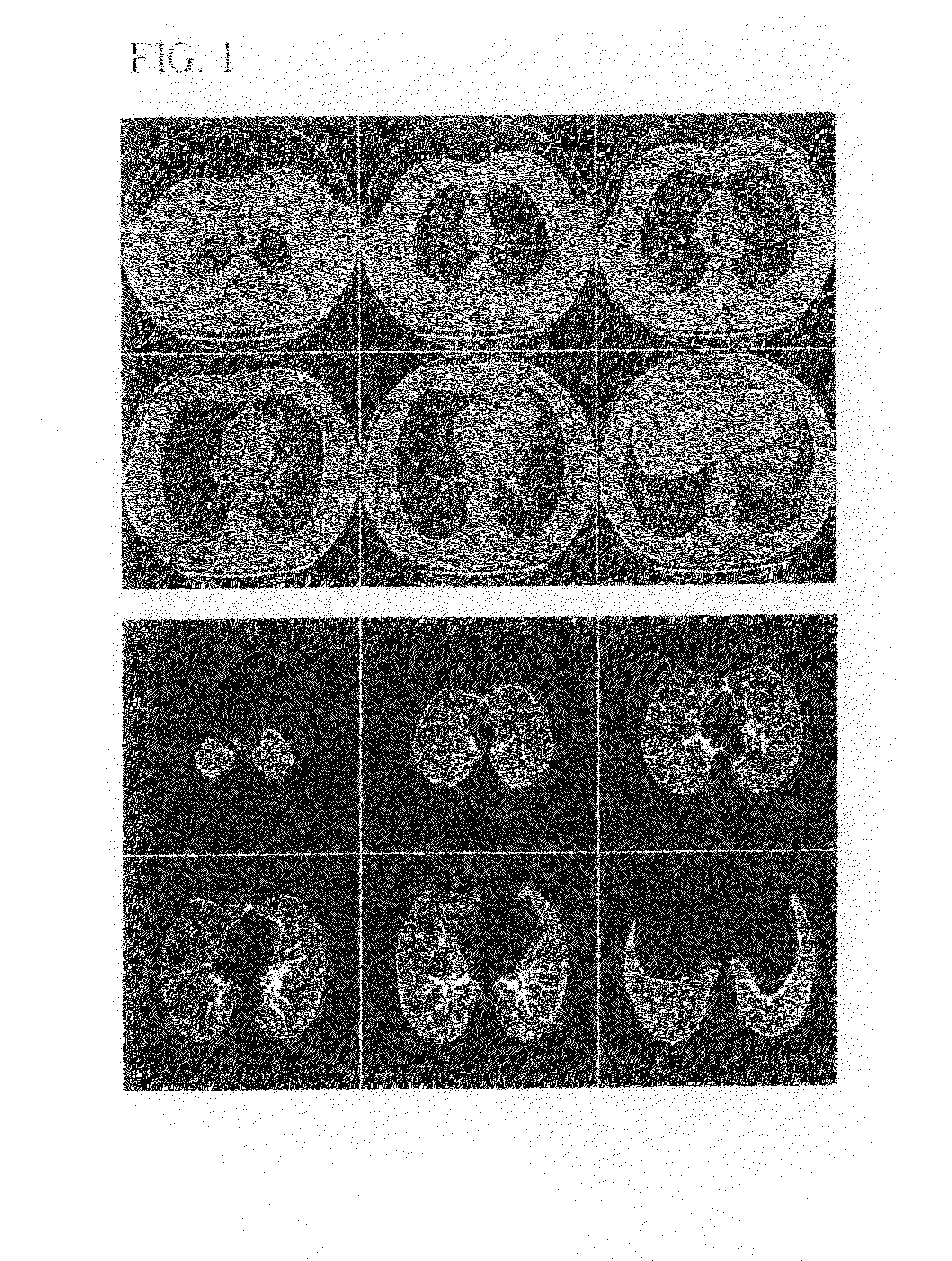 System, method and apparatus for small pulmonary nodule computer aided diagnosis from computed tomography scans