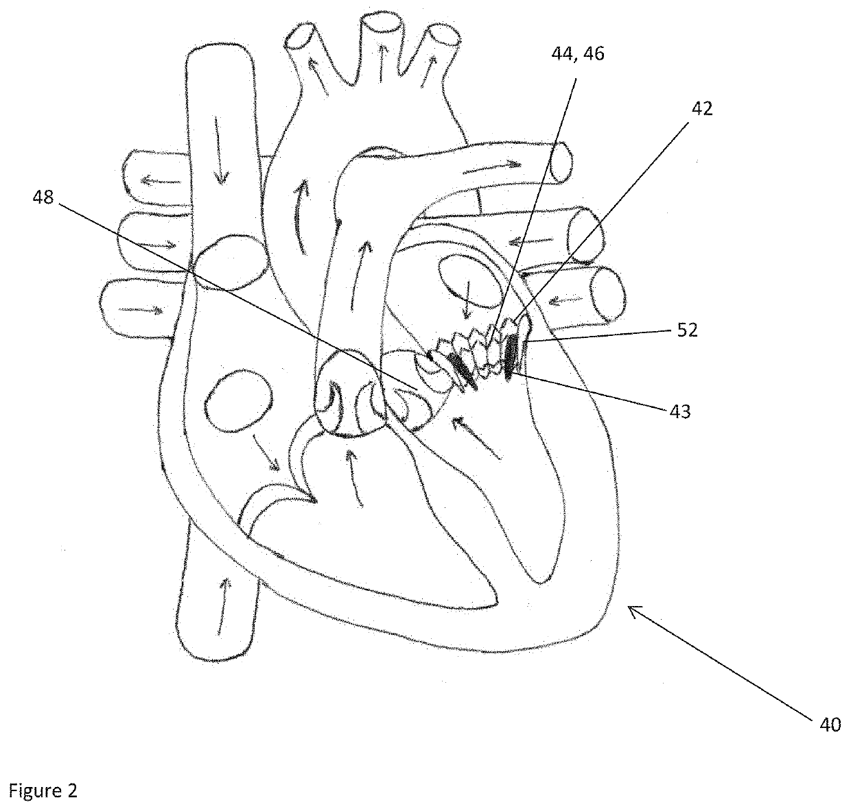 Method and system for determining a risk of hemodynamic compromise after cardiac intervention