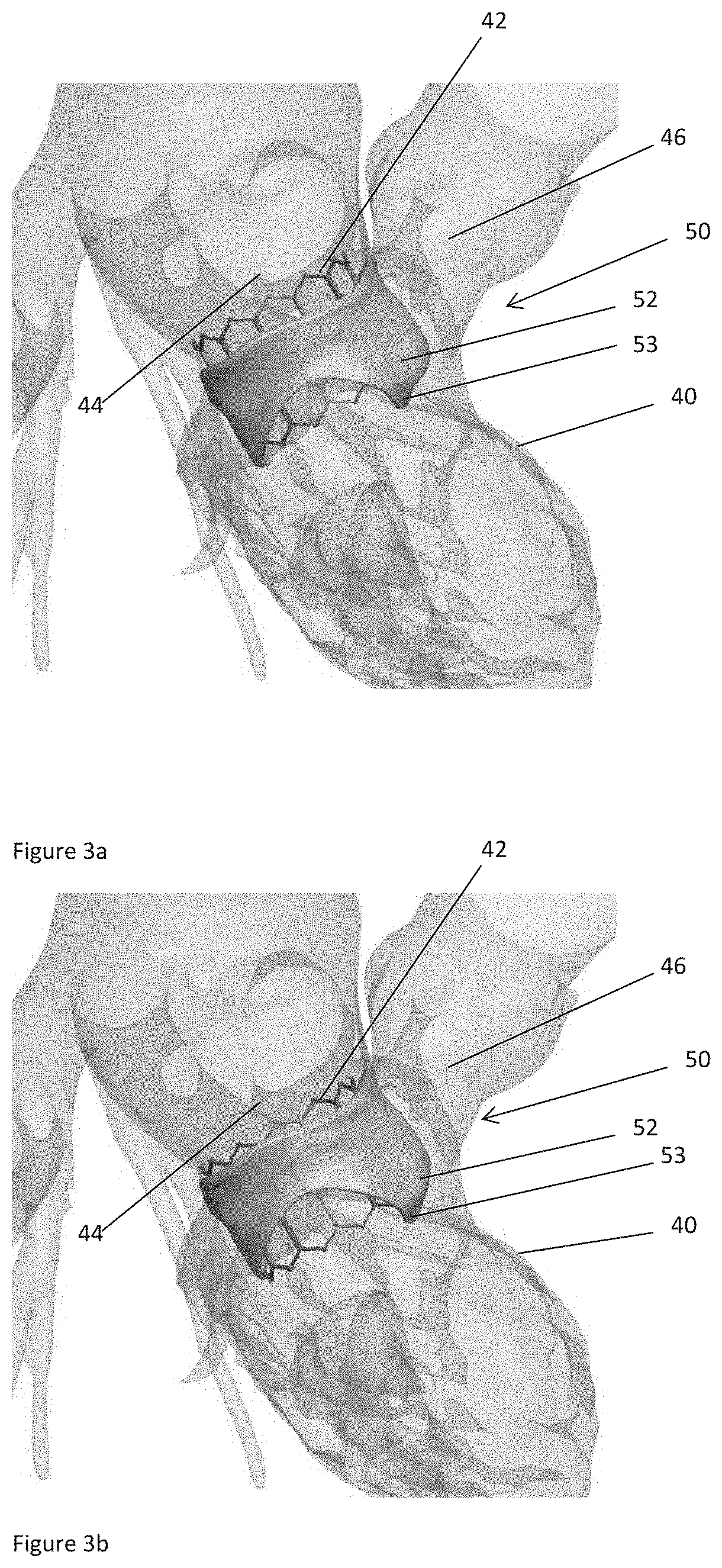 Method and system for determining a risk of hemodynamic compromise after cardiac intervention