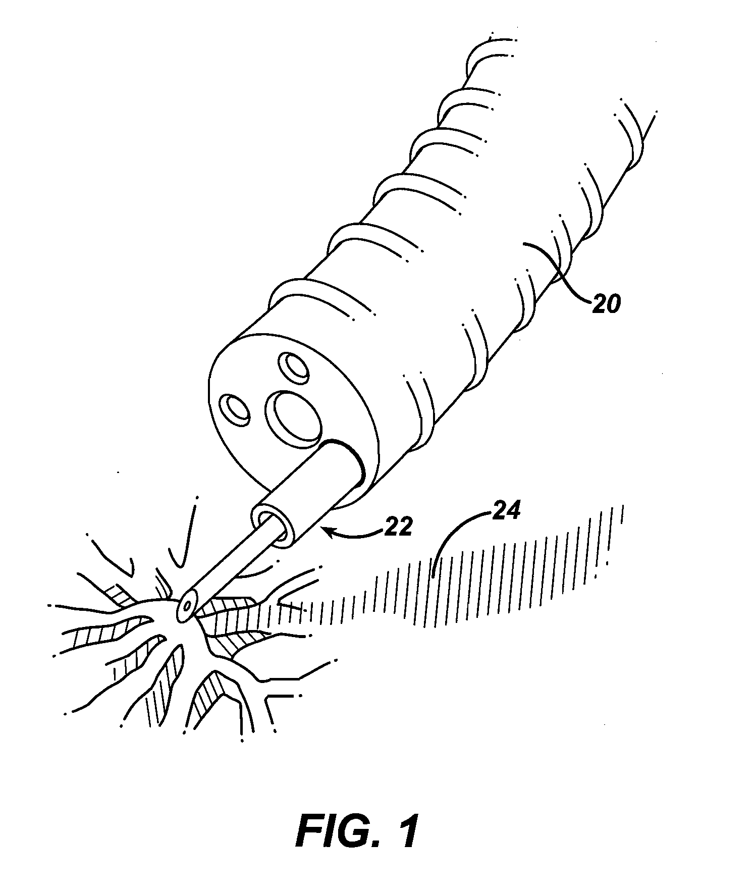 Methods and implants for inducing satiety in the treatment of obesity
