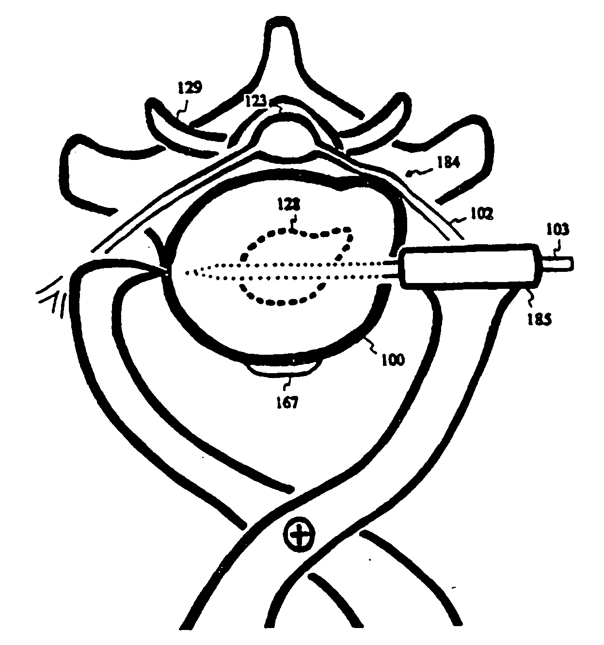 Intervertebral disc inserting device