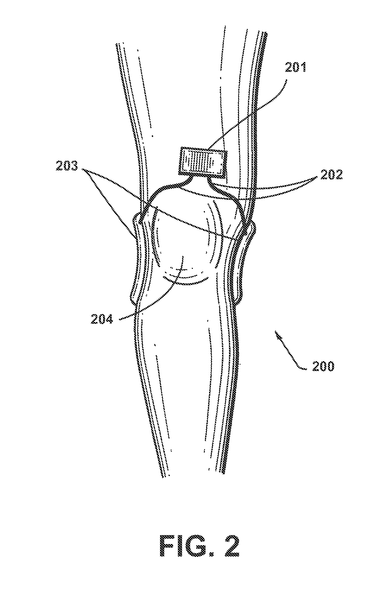 Apparatus and method for electromagnetic treatment of neurological injury or condition caused by a stroke