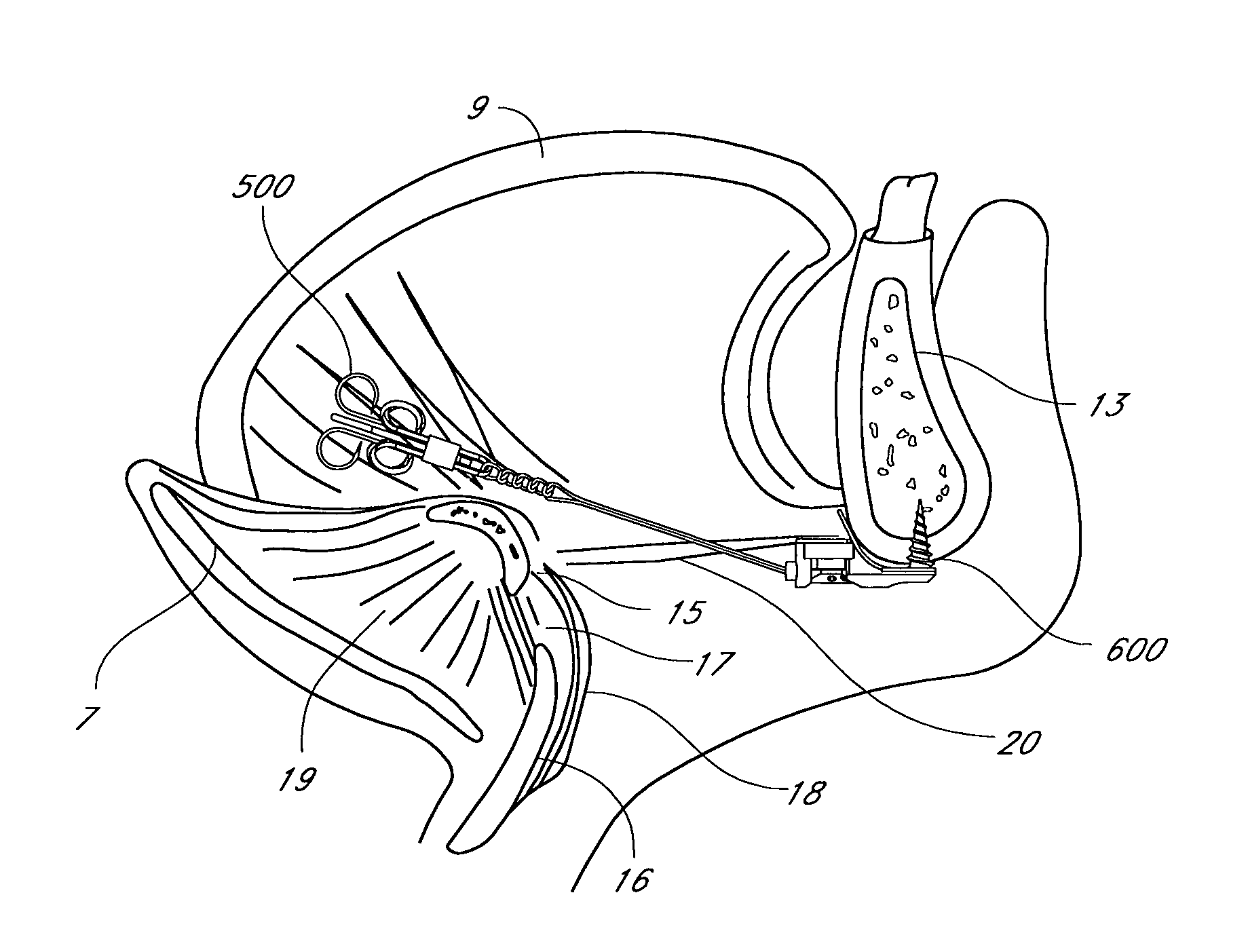 System for adjustable tissue anchors