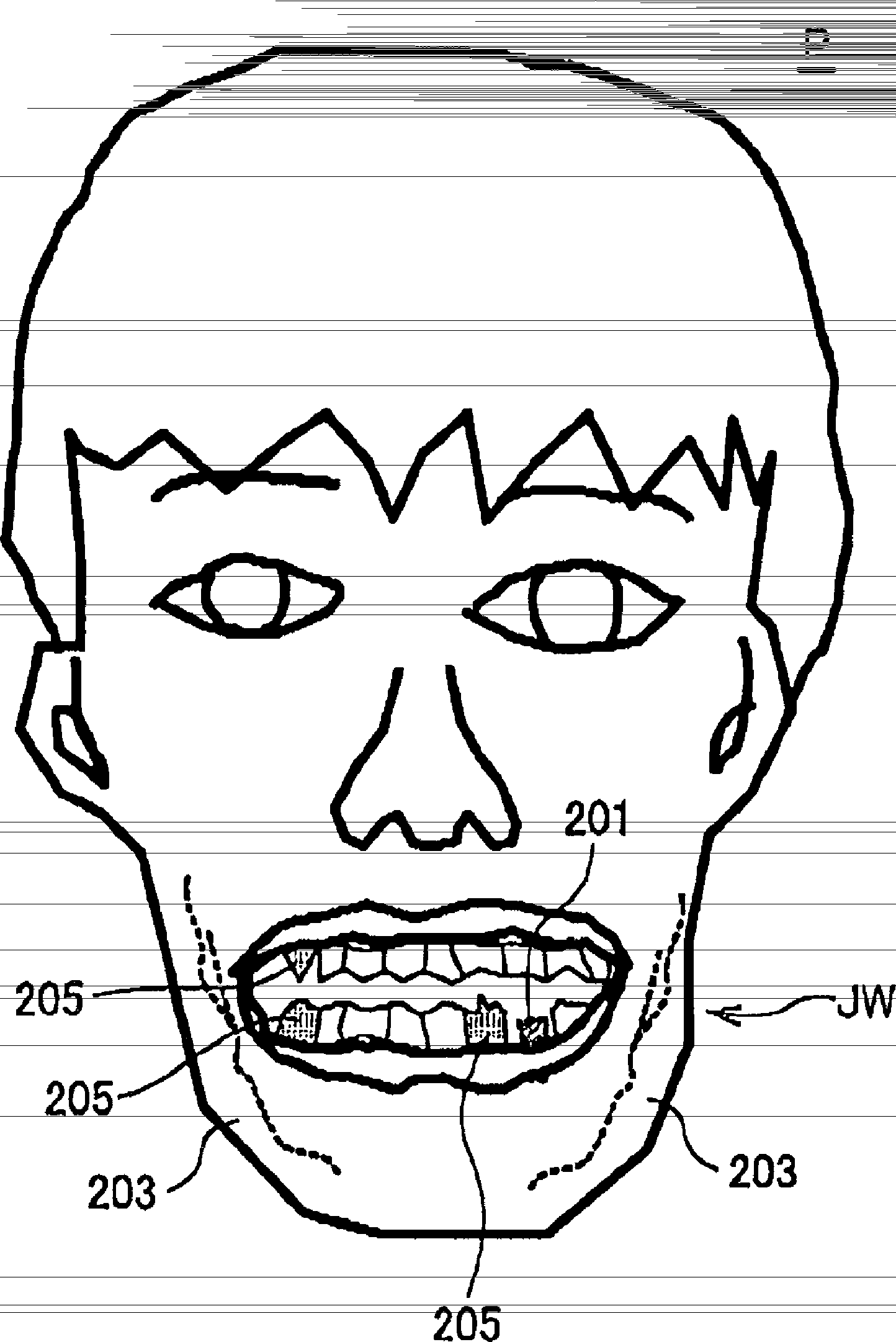 Method and apparatus for supporting dental implantation surgery