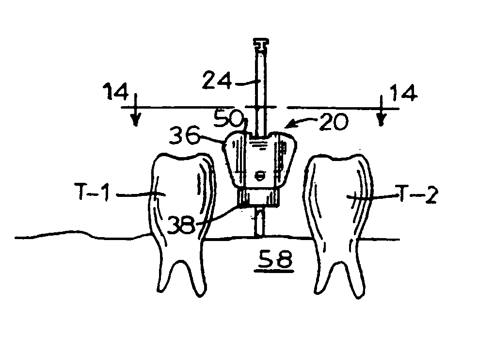 Dental implant drill apparatus and method