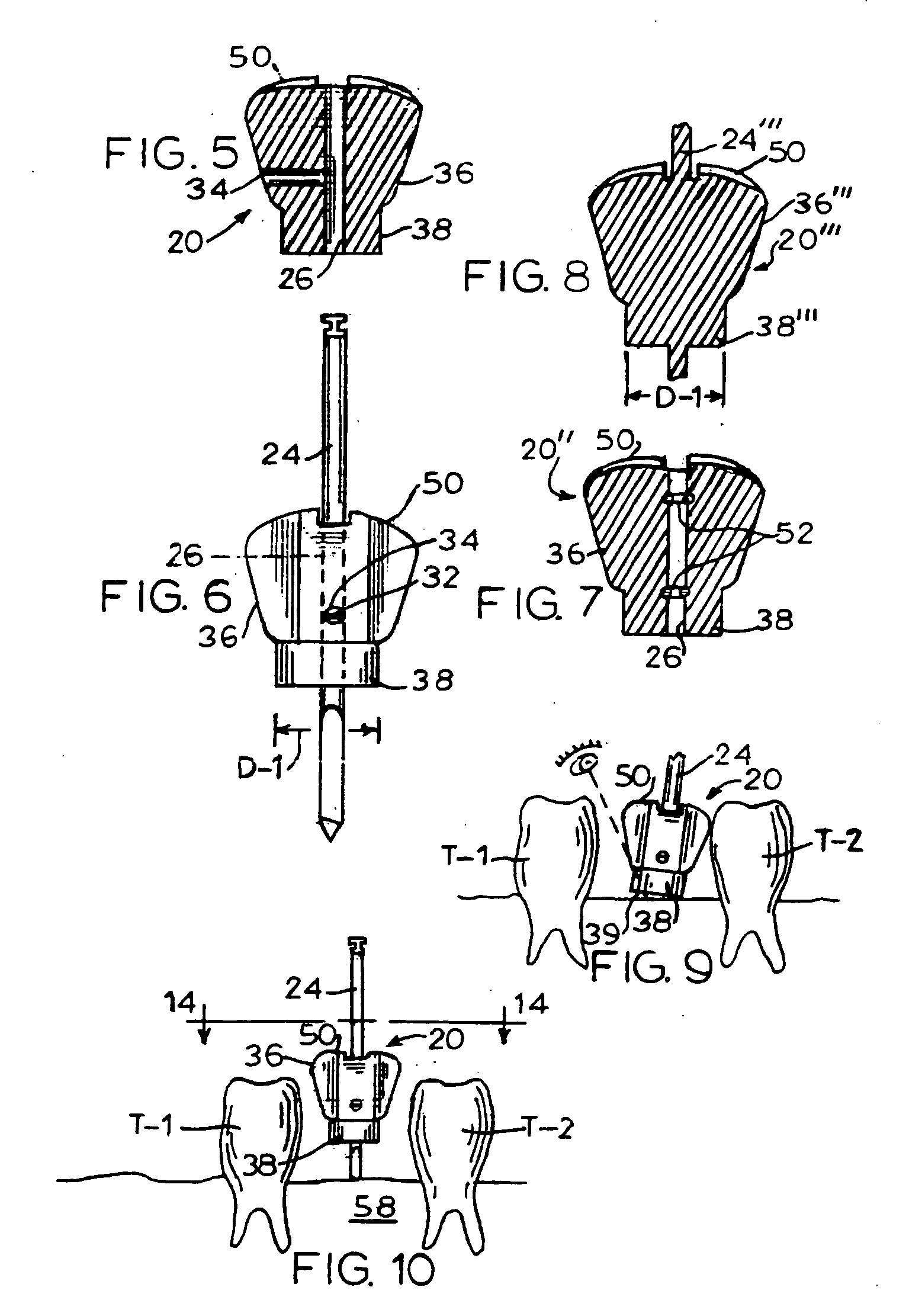 Dental implant drill apparatus and method