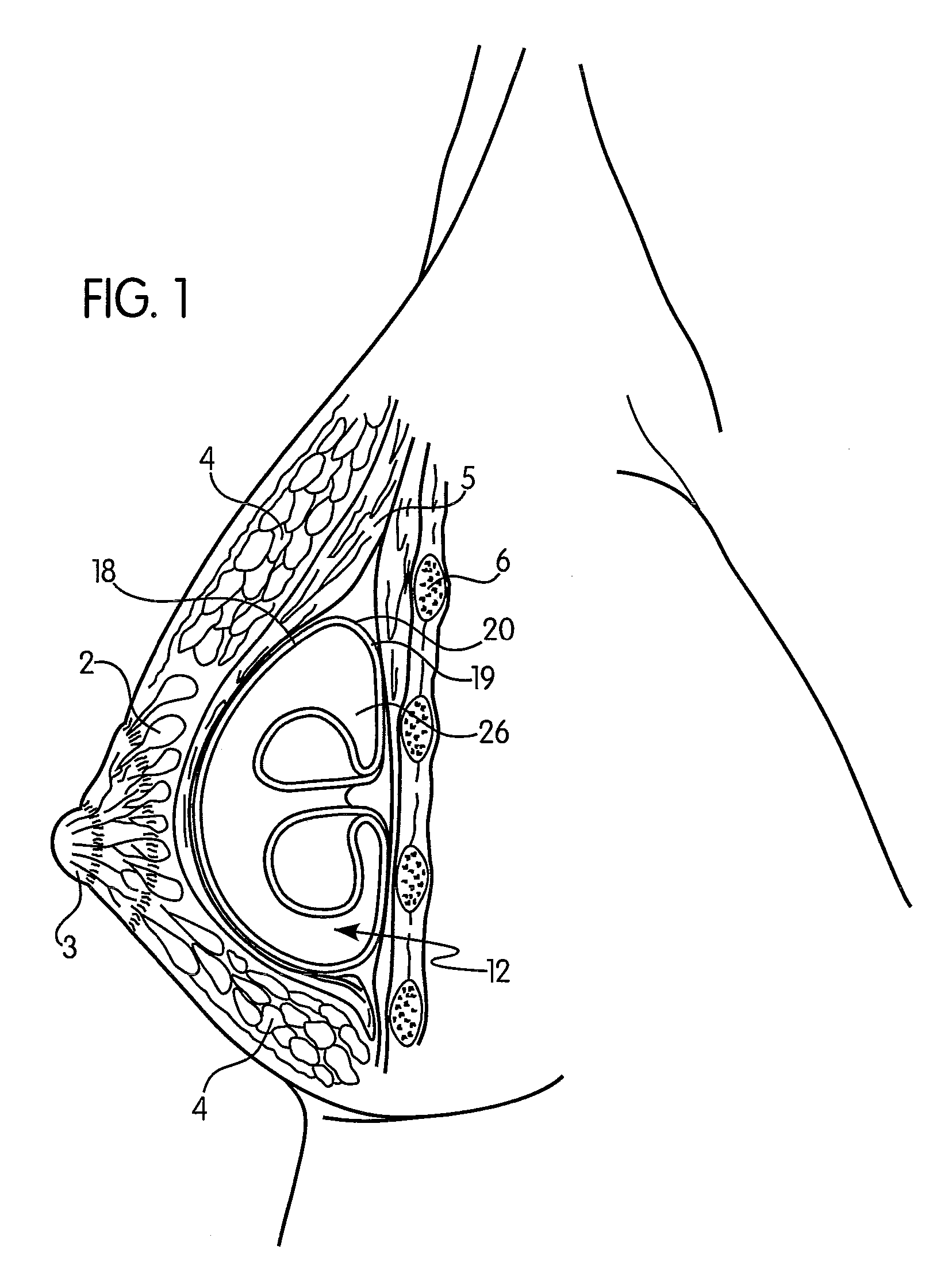Adjustable implant with self-sealing elastomeric membrane and methods of fabrication thereof