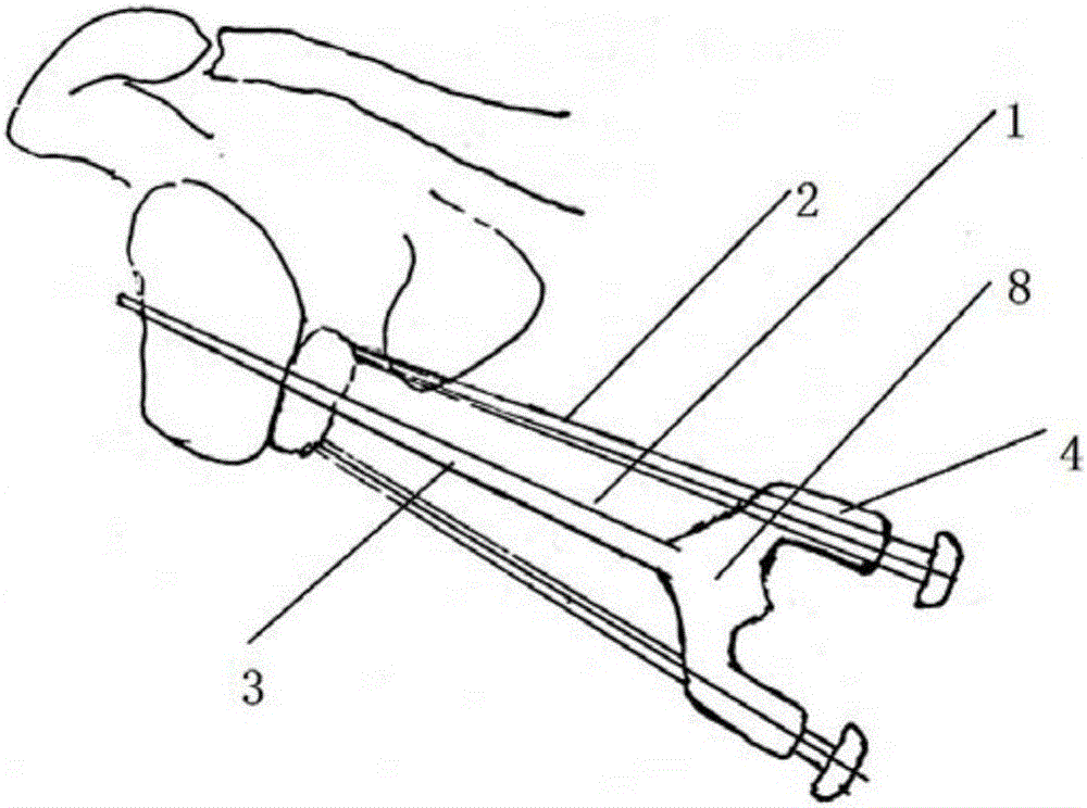 A surgical double-barrel locator