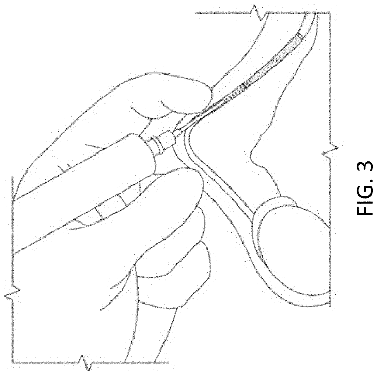 Methods for implanting and reversing stimuli-responsive implants