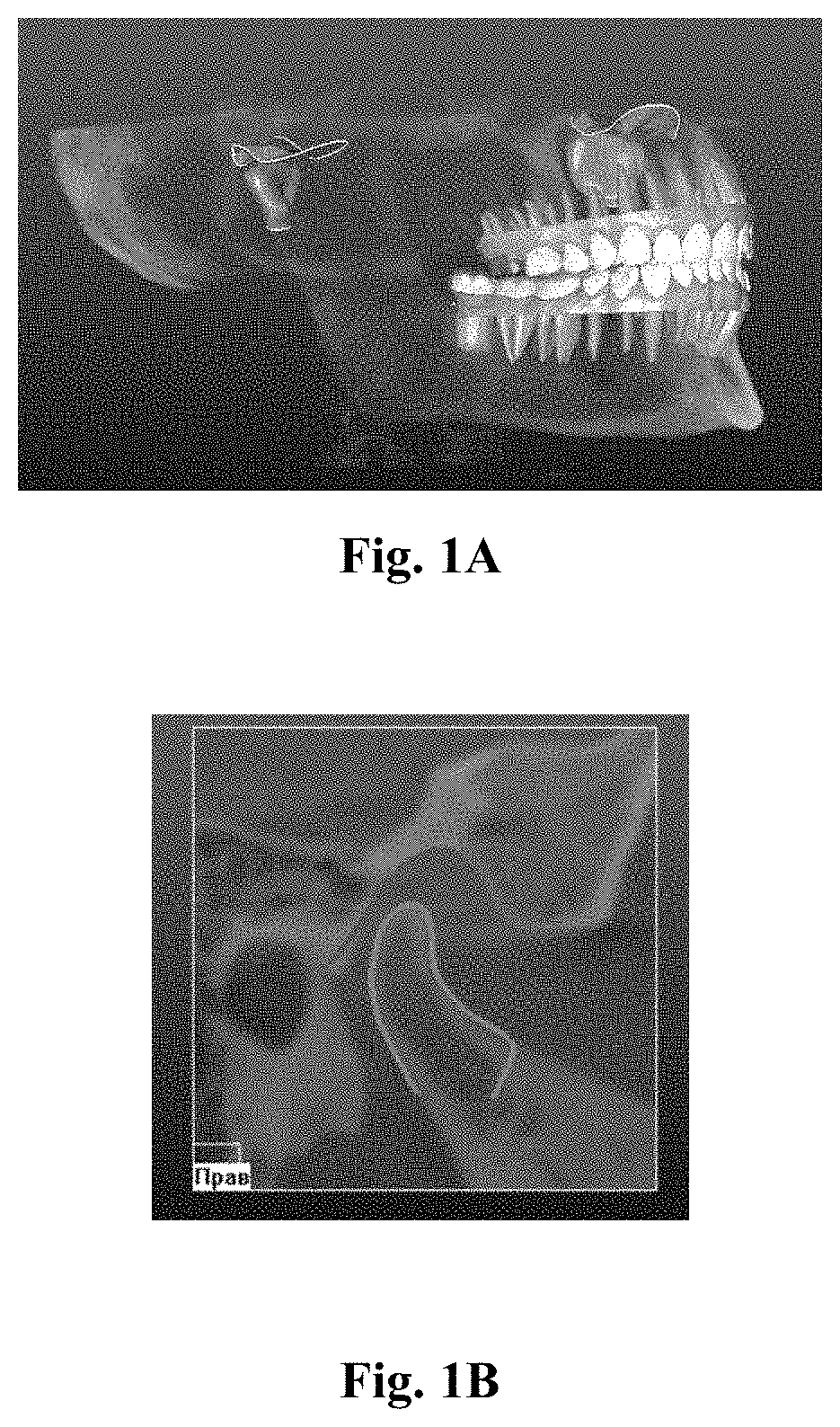 Method for using a dynamic virtual articulator for simulating occlusion when designing a dental prosthesis for a patient, and data carrier